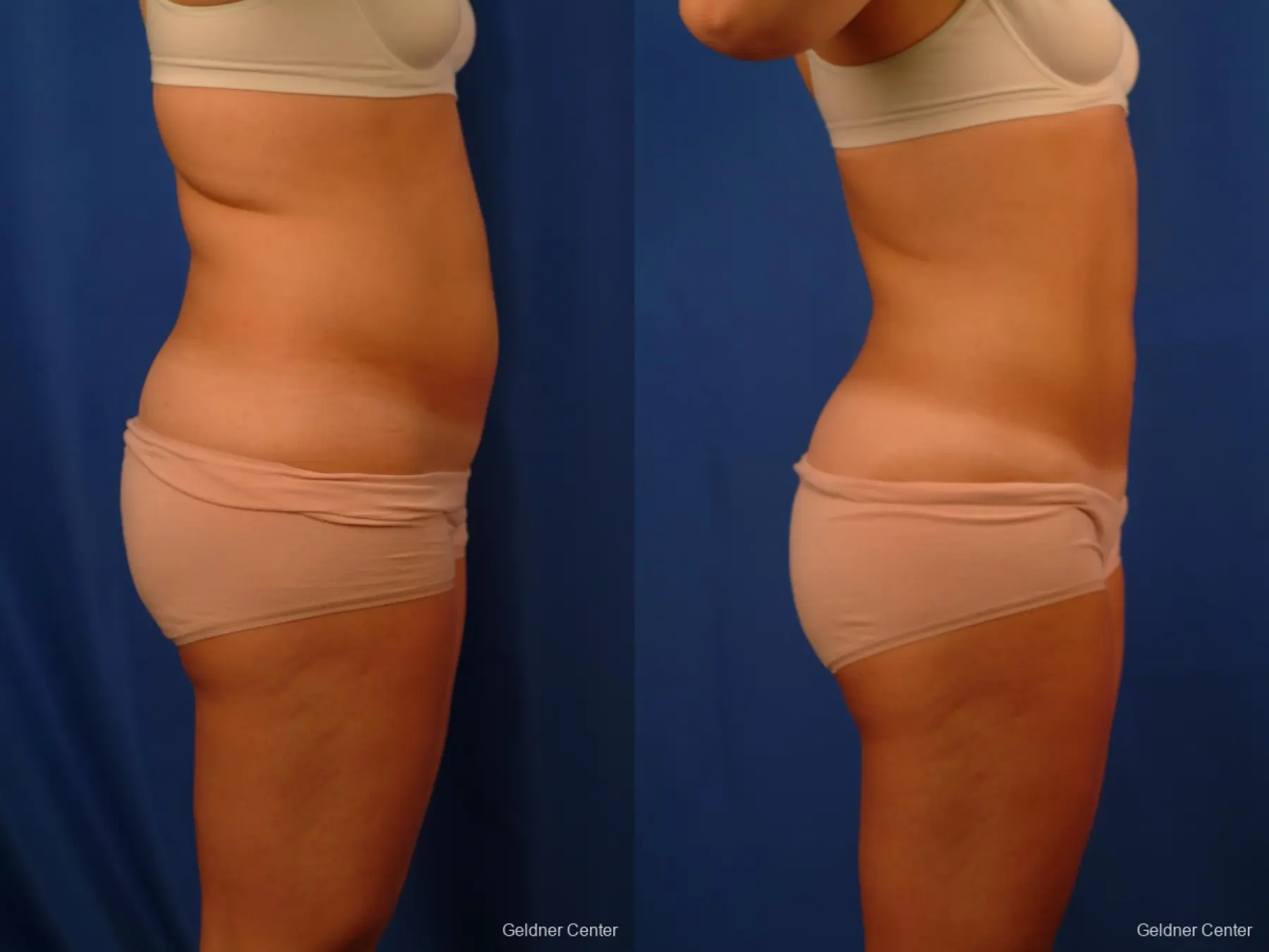 Liposuction Before & After Gallery: Patient 12