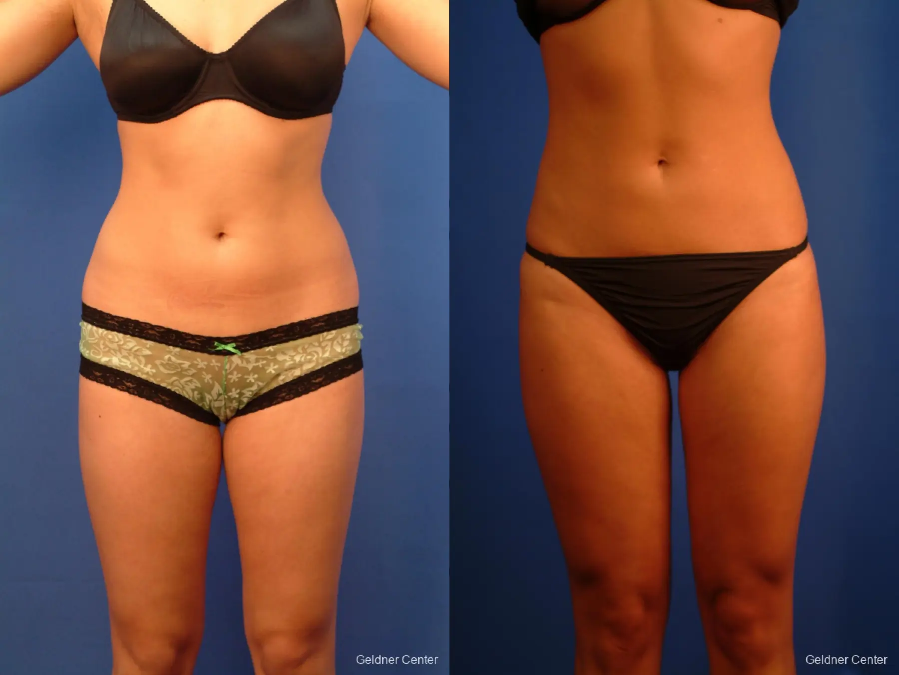 Liposuction: Patient 14 - Before and After  