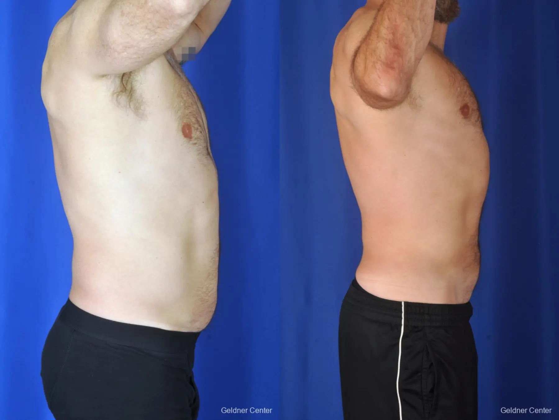 Liposuction For Men: Patient 7 - Before and After 3