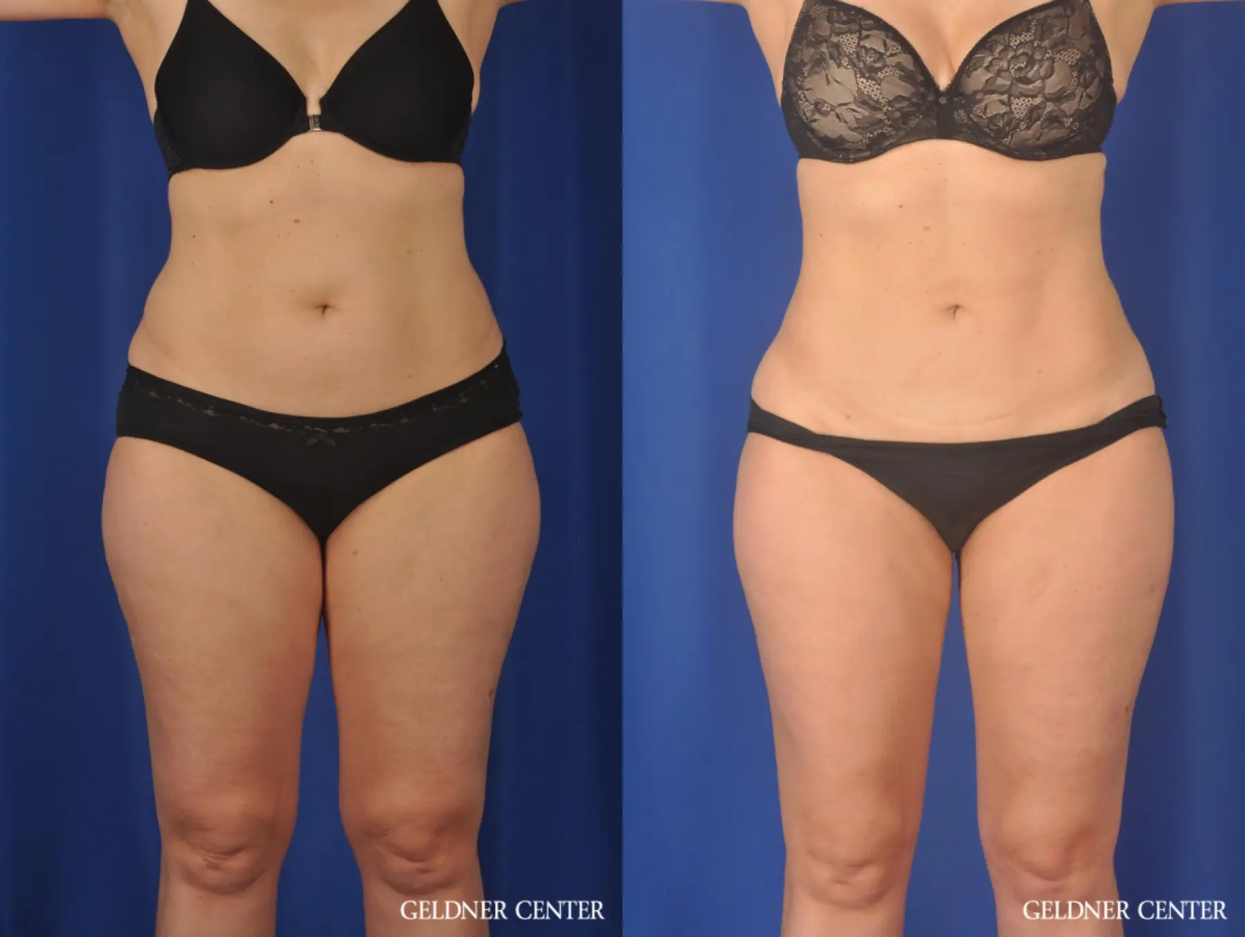 Liposuction: Patient 32 - Before and After  