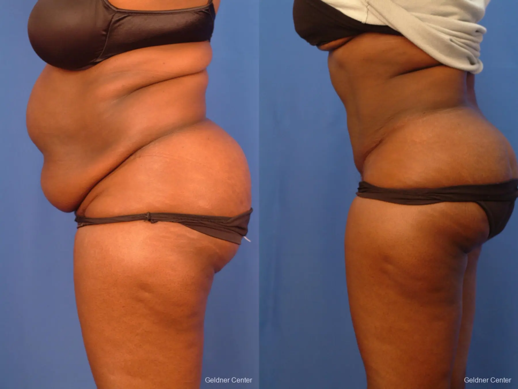 Liposuction: Patient 19 - Before and After 4
