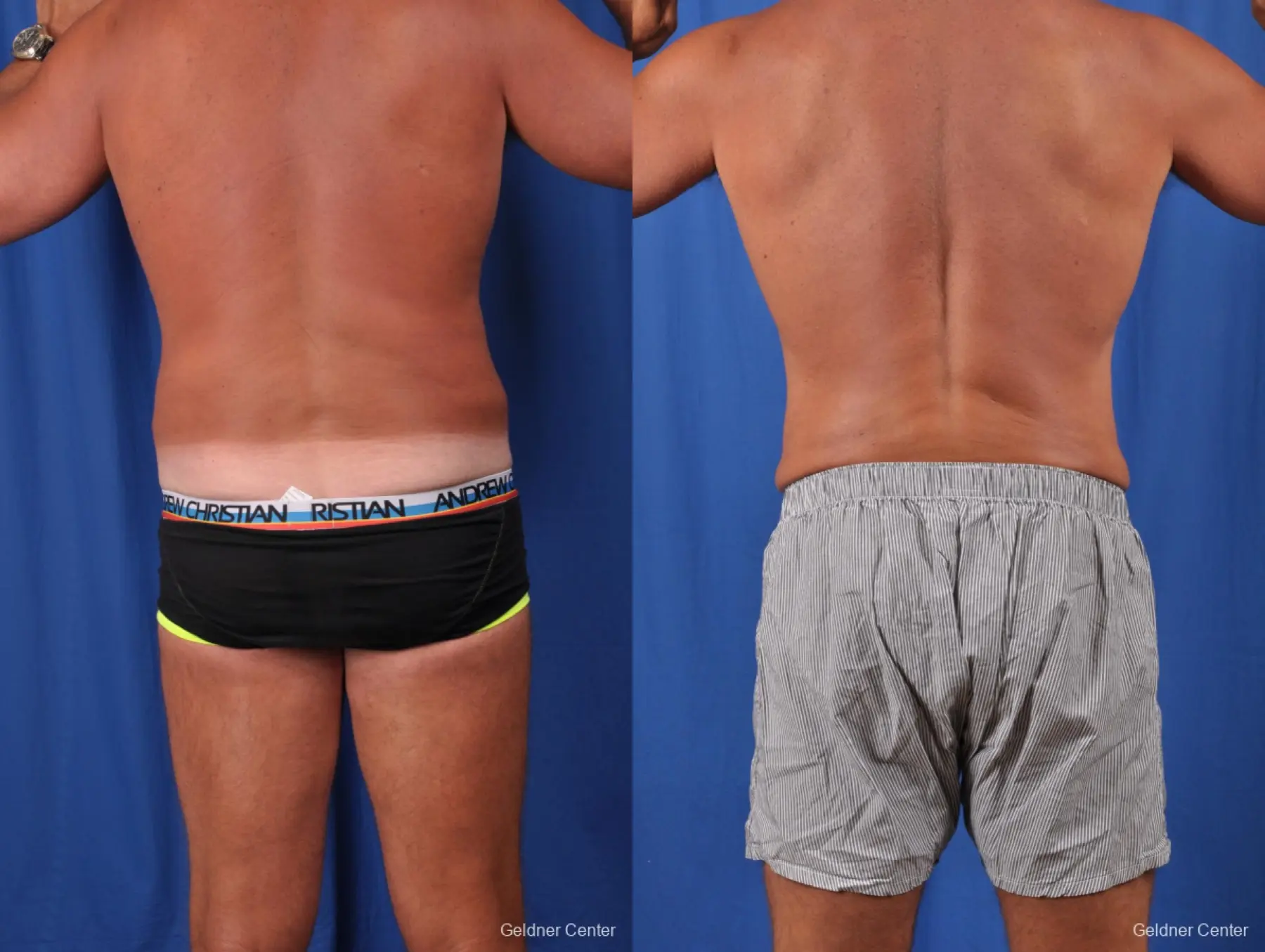 Liposuction For Men: Patient 5 - Before and After 4