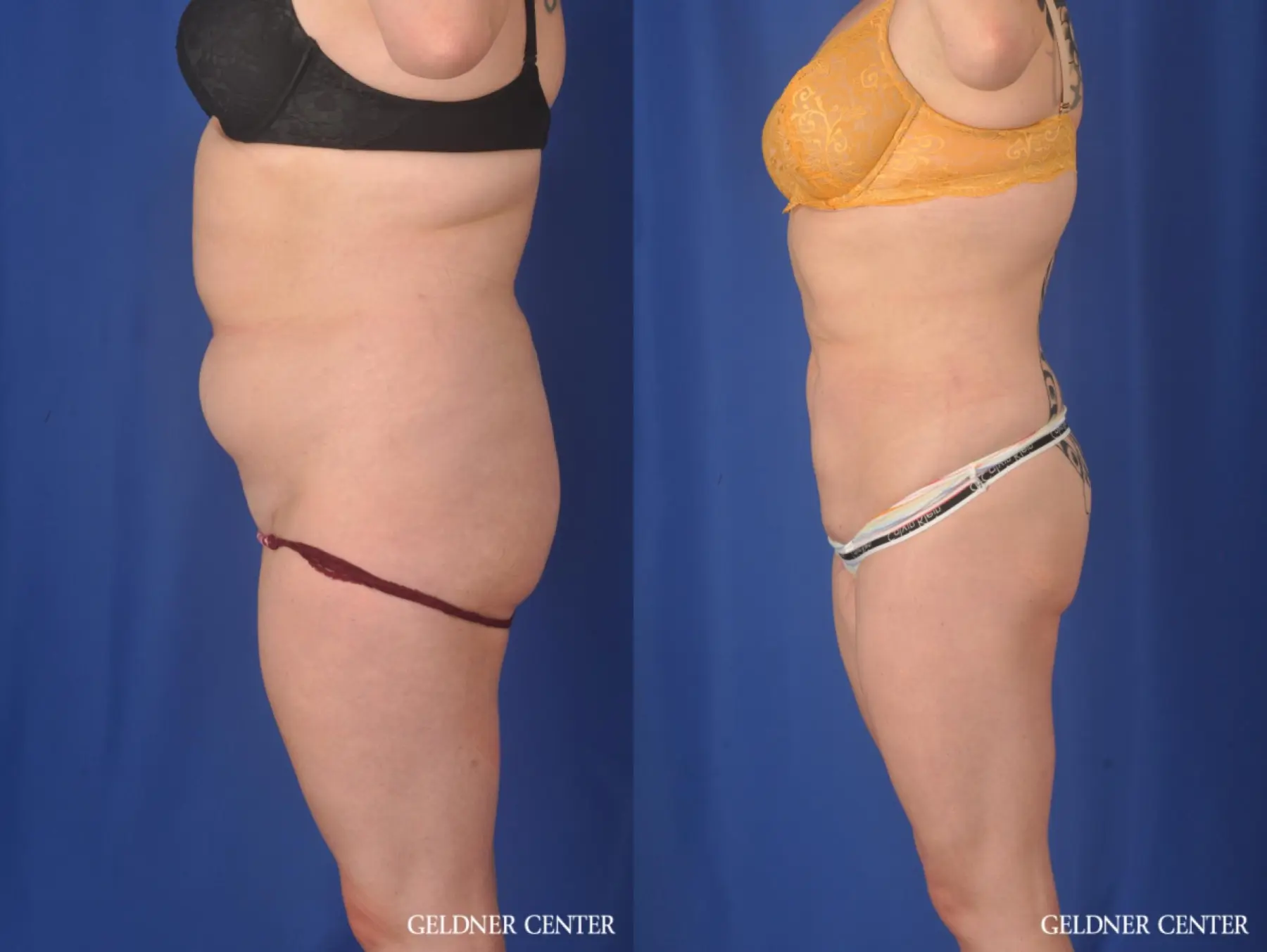 Liposuction: Patient 45 - Before and After 4
