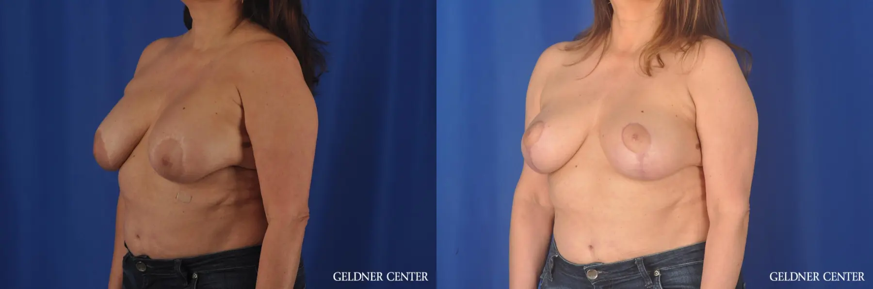 Liposuction: Patient 35 - Before and After 4
