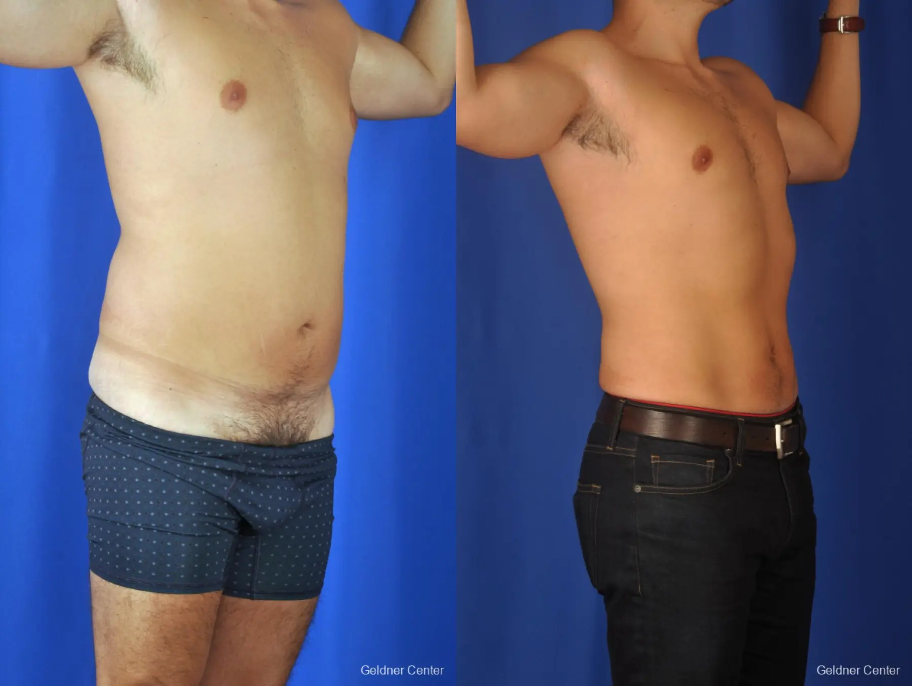 Liposuction For Men: Patient 4 - Before and After 2
