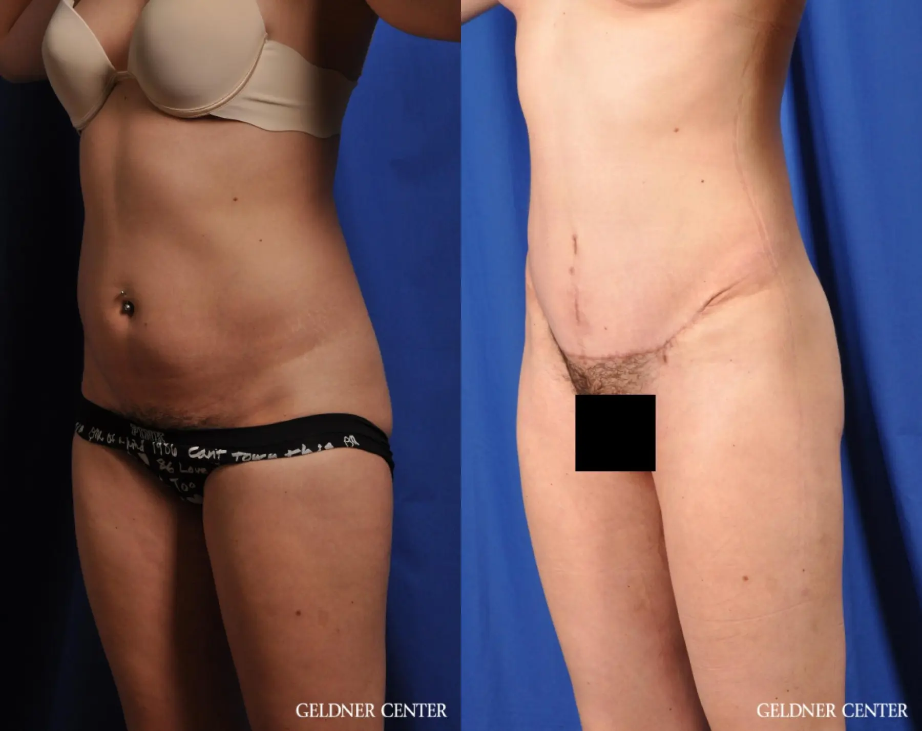 Liposuction: Patient 41 - Before and After 5