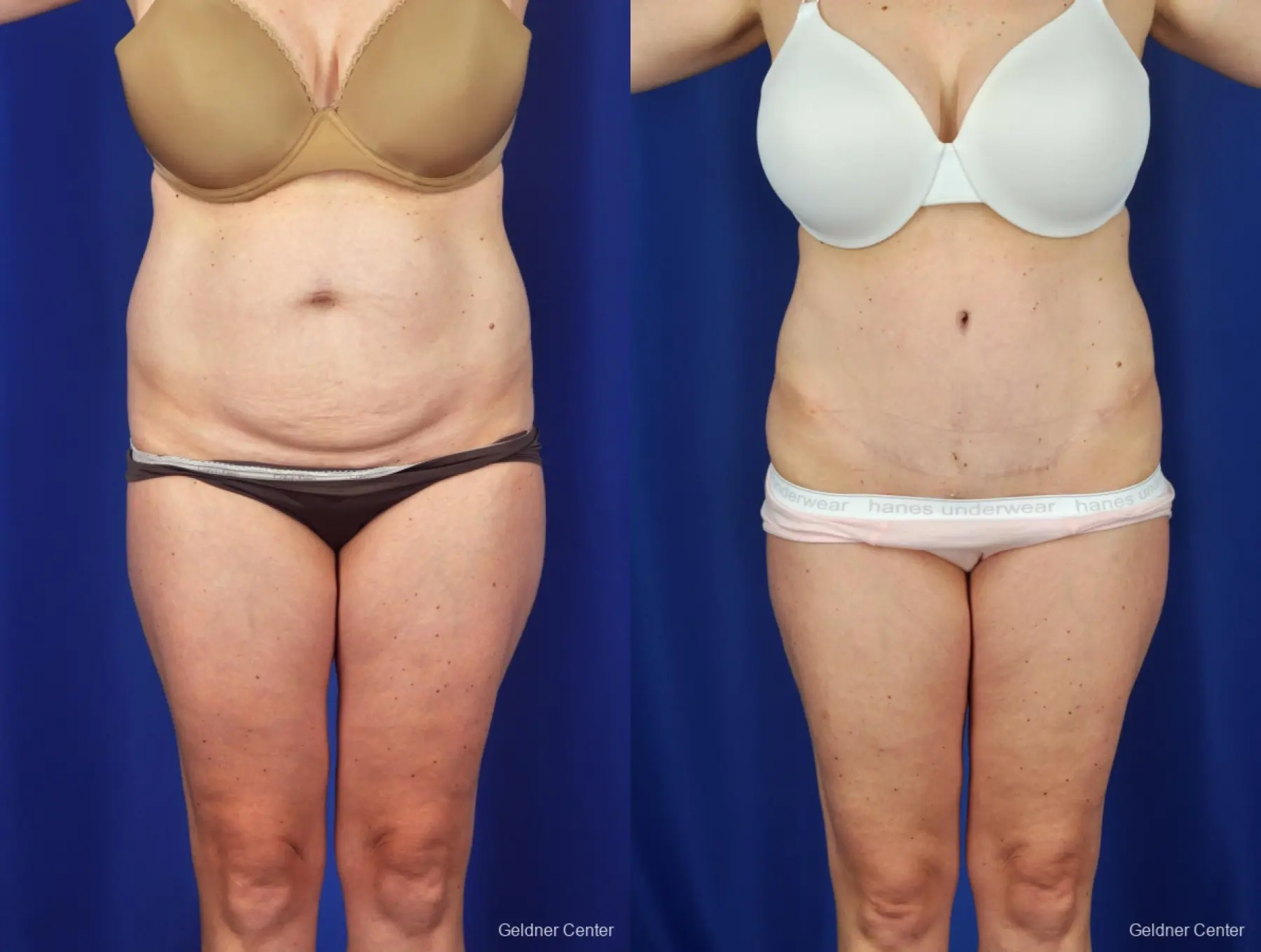 Liposuction: Patient 6 - Before and After  