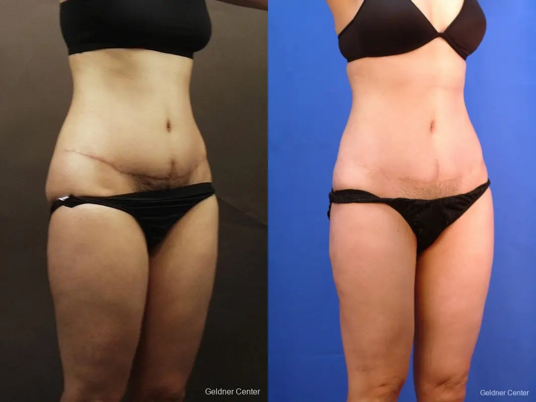 Liposuction: Patient 5 - Before and After 4