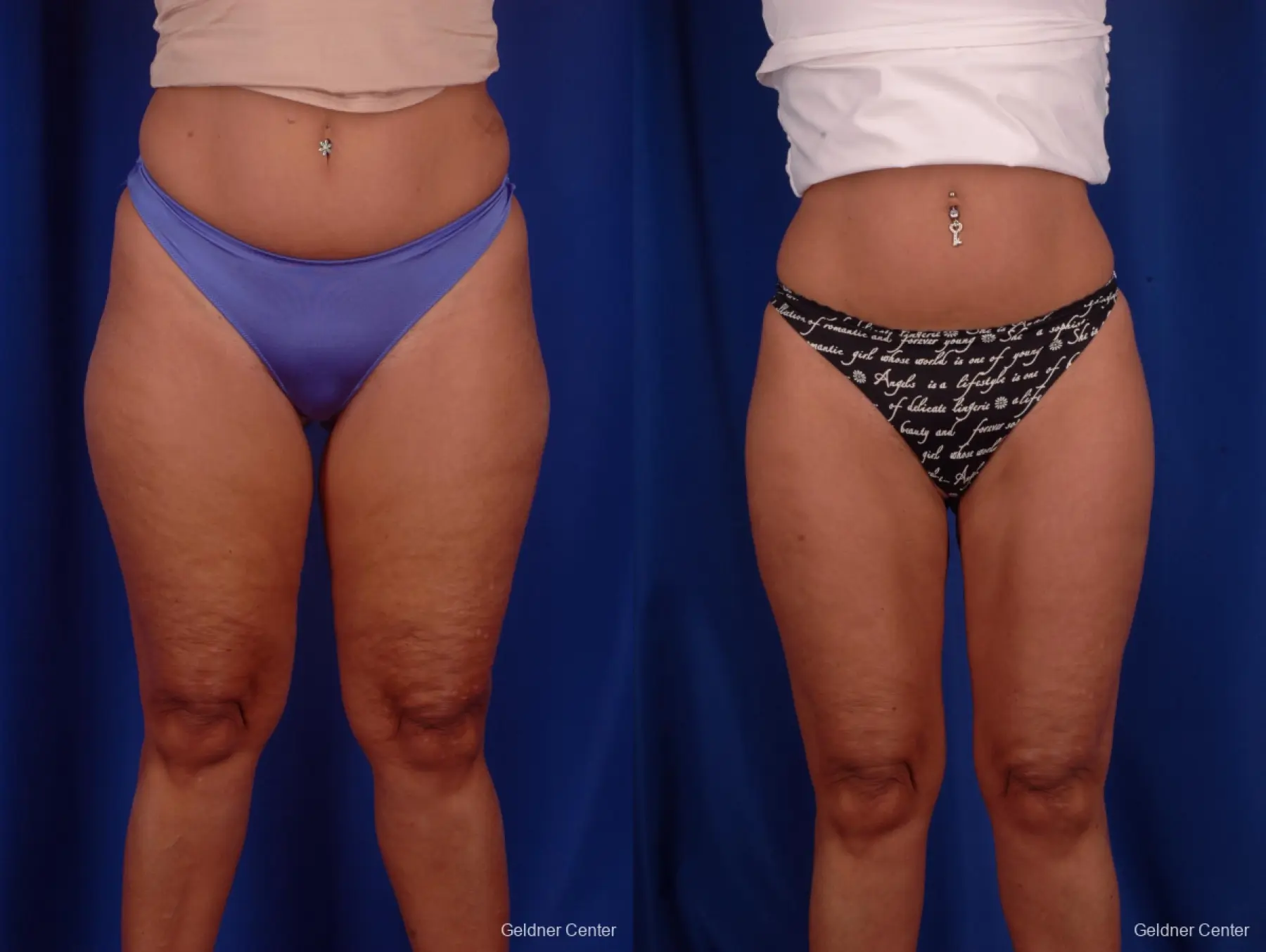 Liposuction: Patient 7 - Before and After  