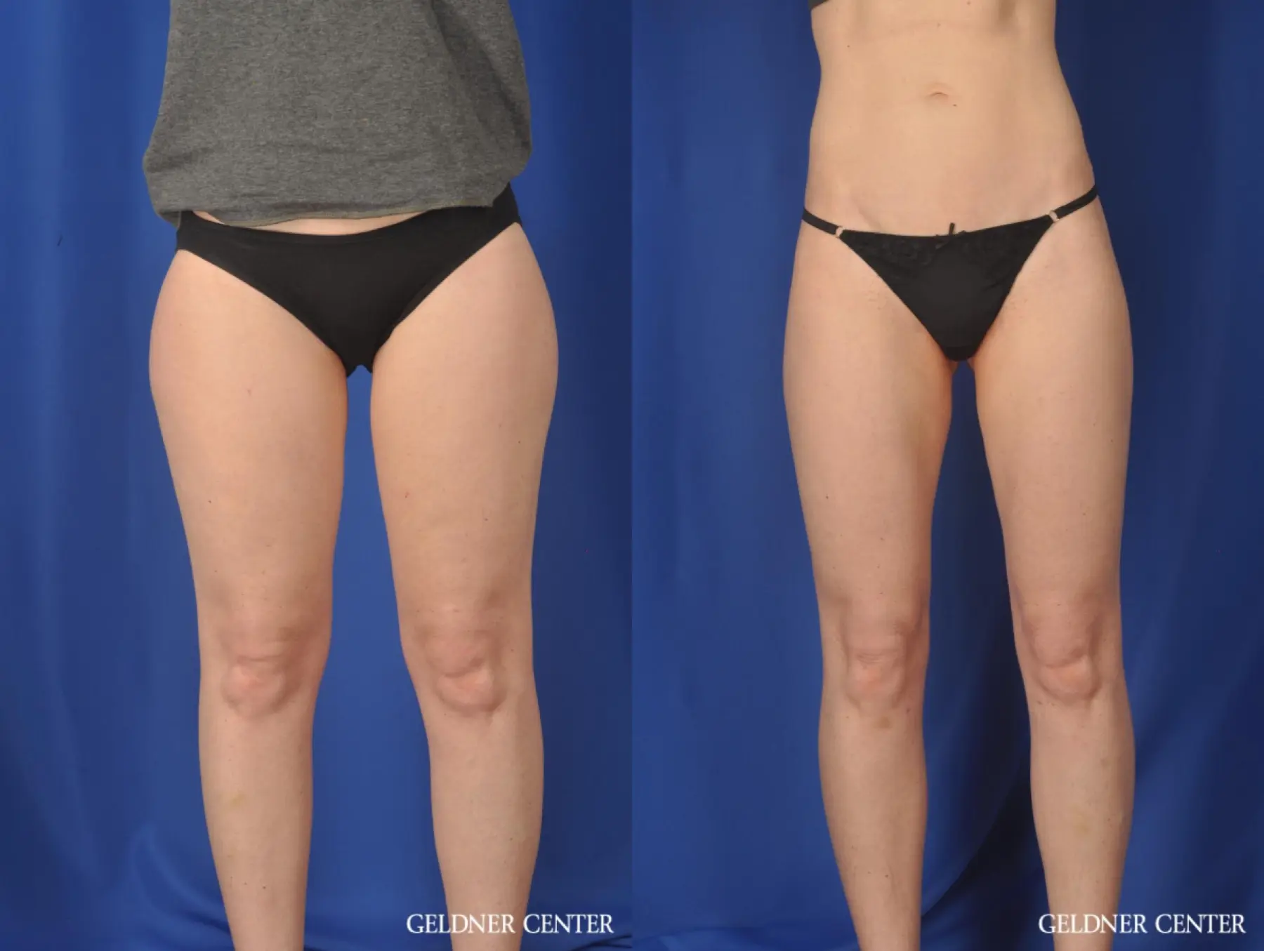 Liposuction: Patient 36 - Before and After  