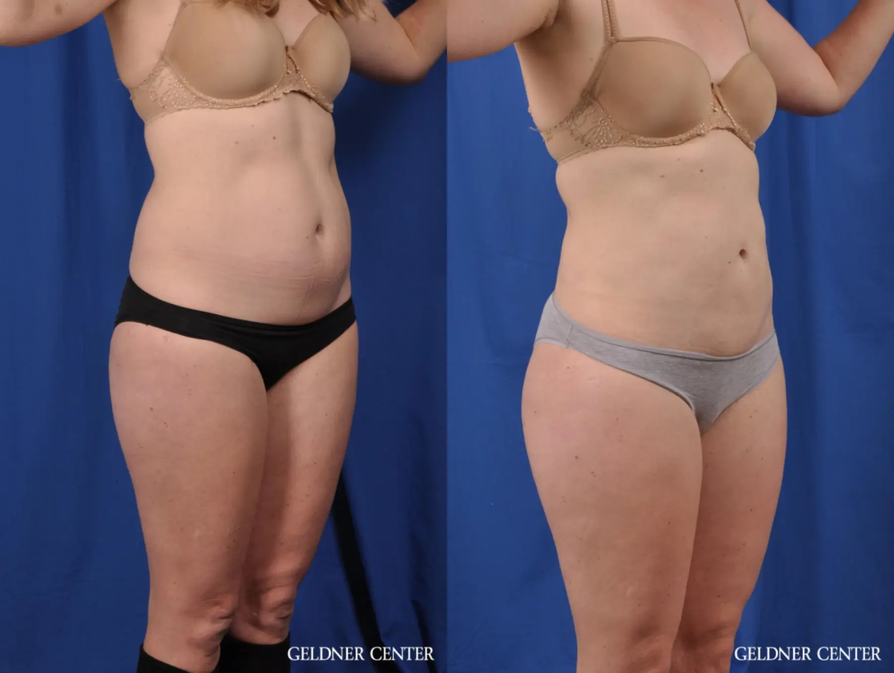 Liposuction: Patient 48 - Before and After 2