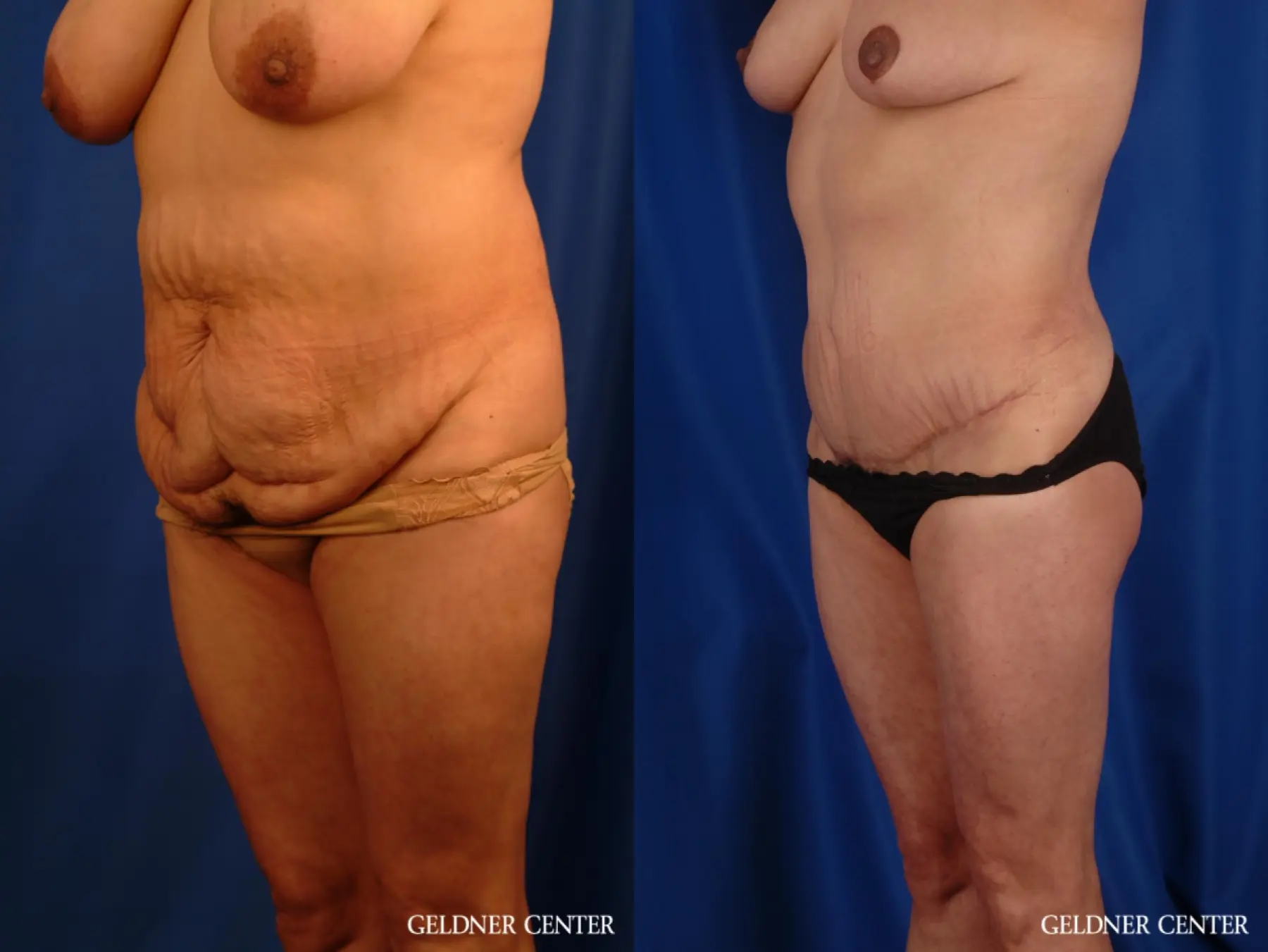 Liposuction: Patient 21 - Before and After 5