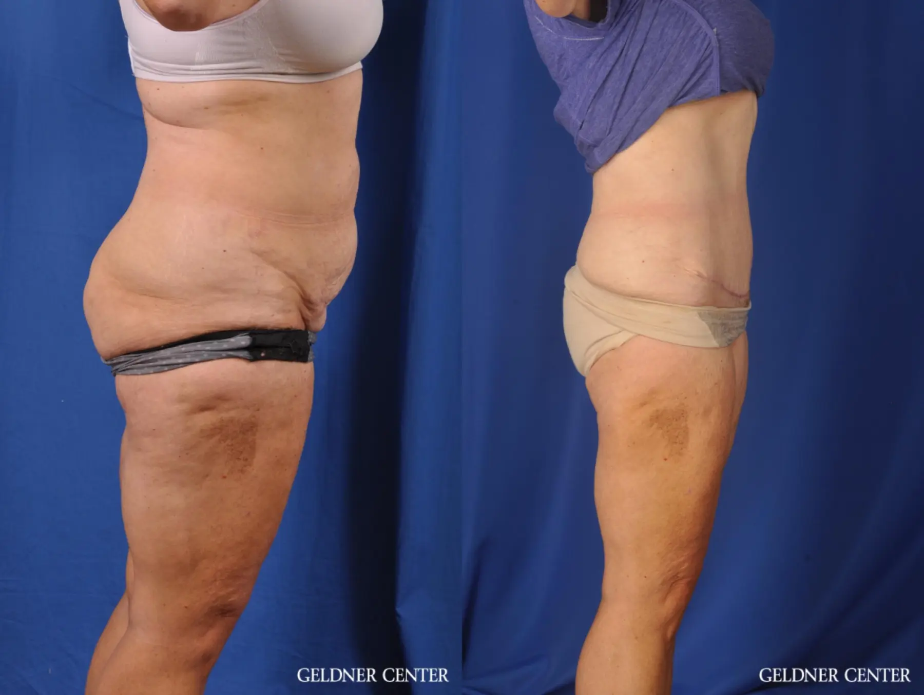 Liposuction: Patient 34 - Before and After 3