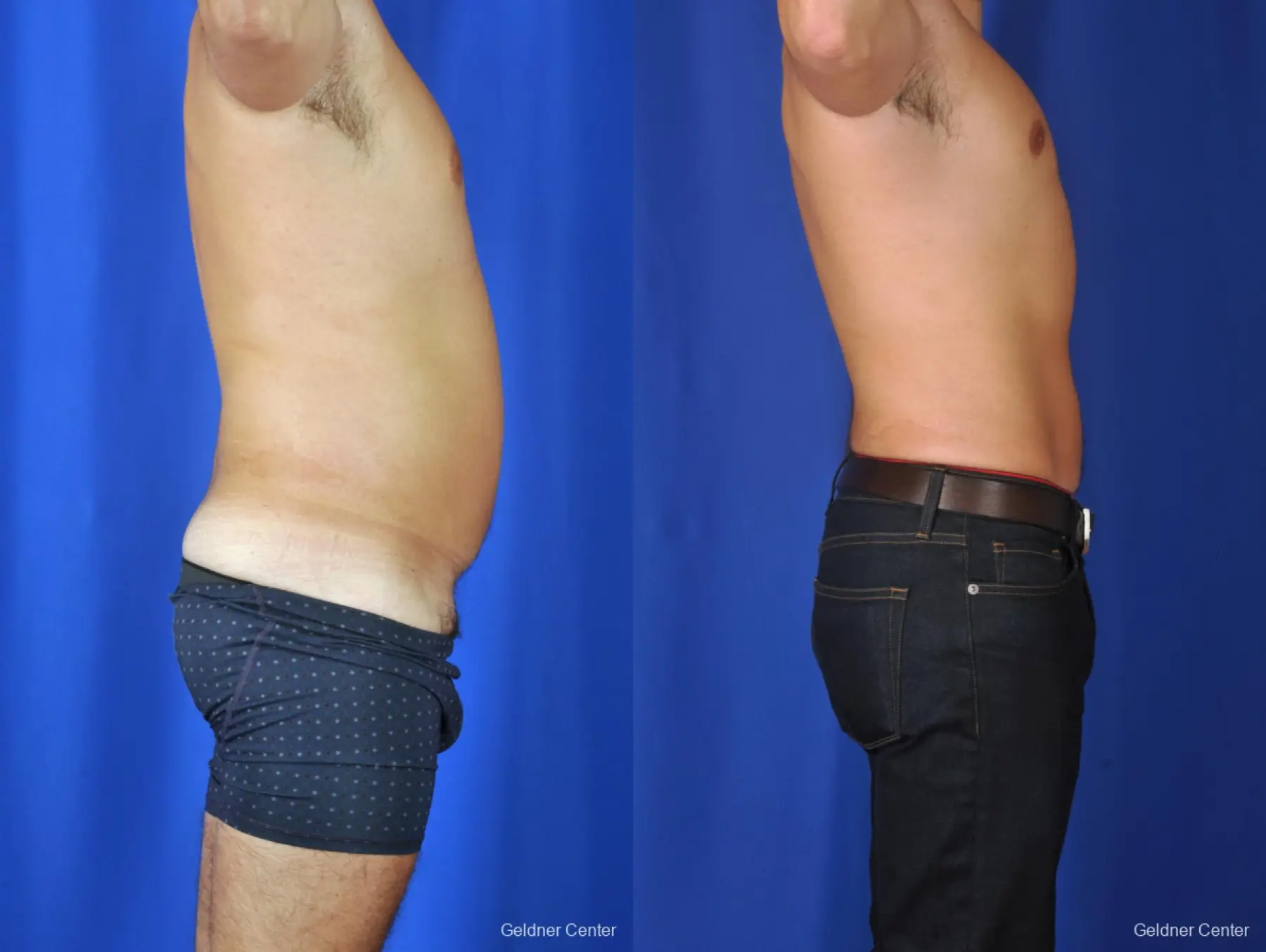 Liposuction For Men: Patient 4 - Before and After 3