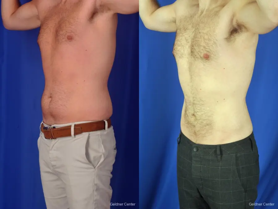 Liposuction For Men: Patient 3 - Before and After 5
