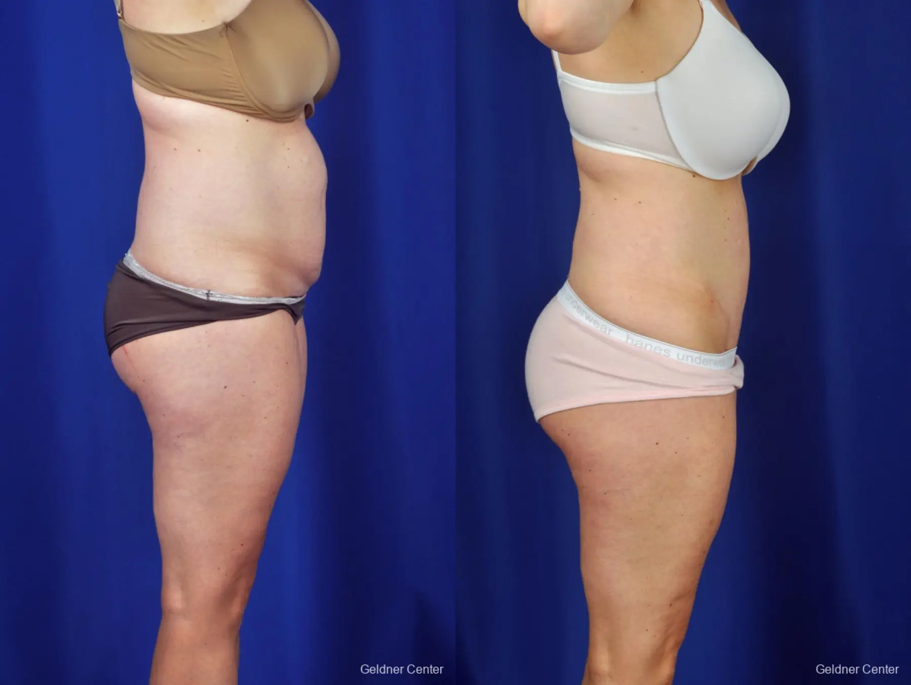 Liposuction: Patient 6 - Before and After 3
