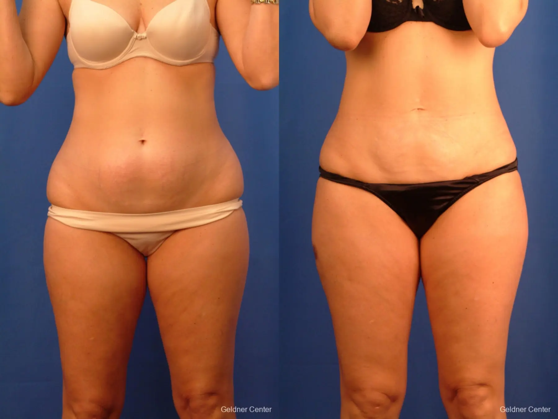 Liposuction: Patient 15 - Before and After  