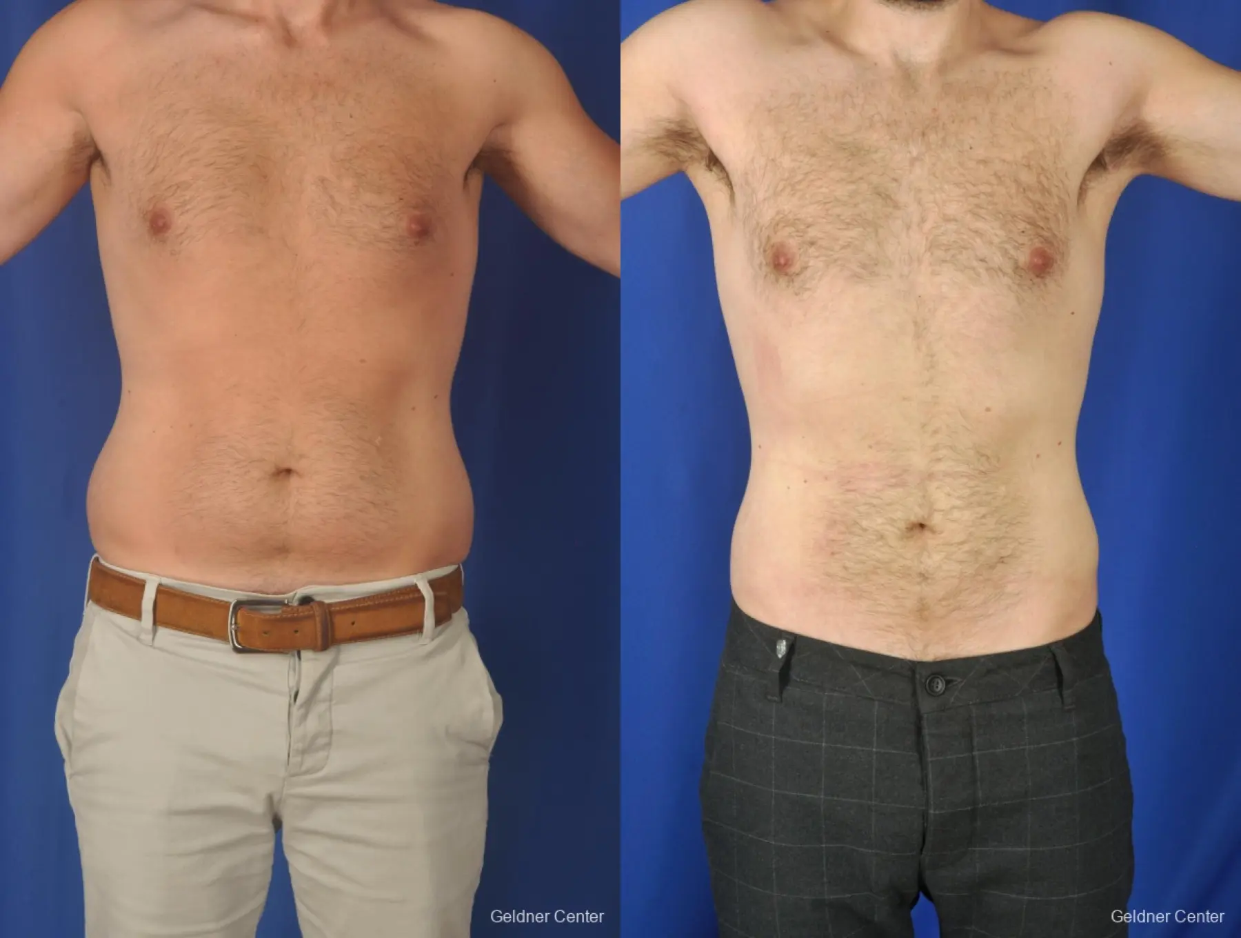 Liposuction For Men: Patient 3 - Before and After 1