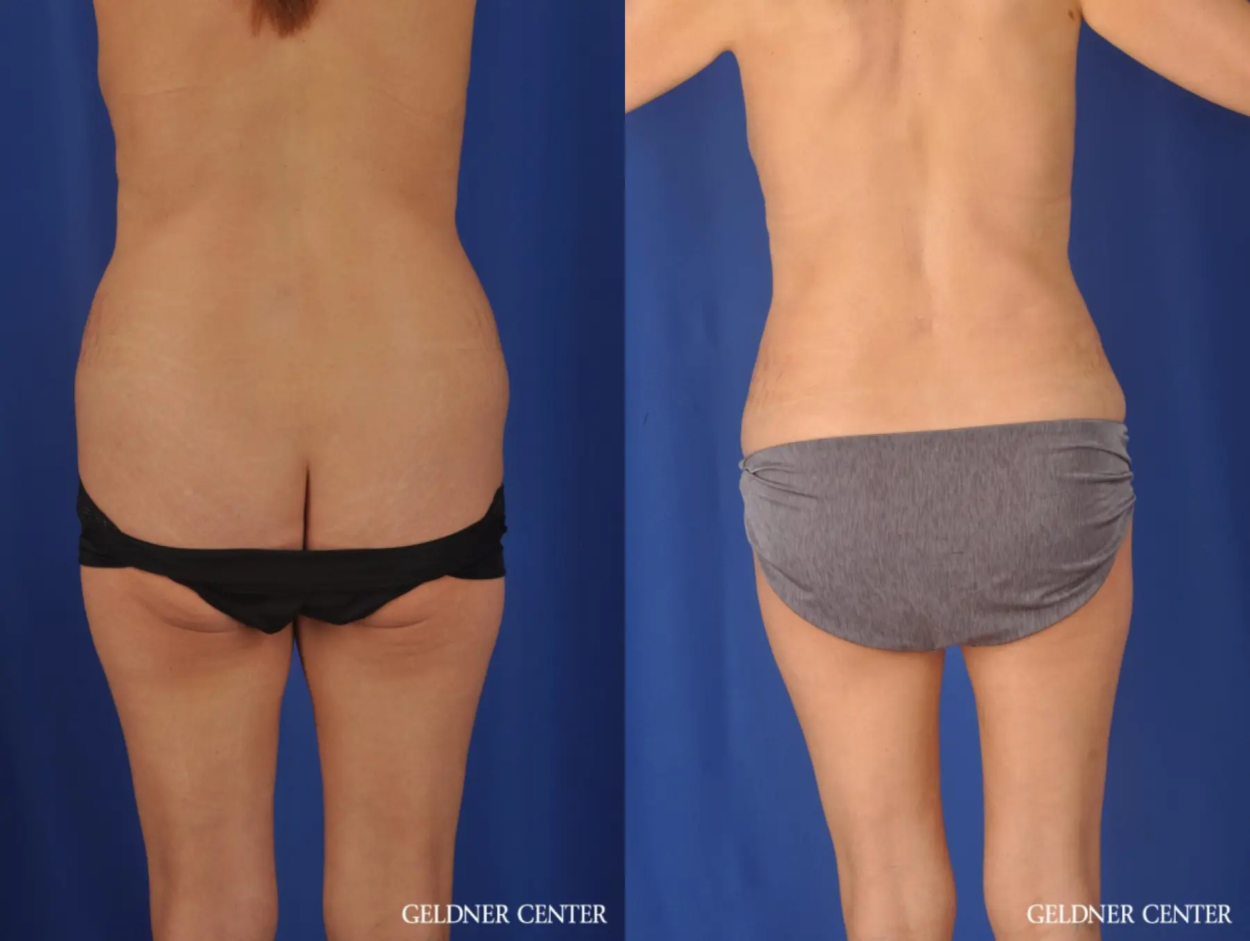 Liposuction: Patient 37 - Before and After 4