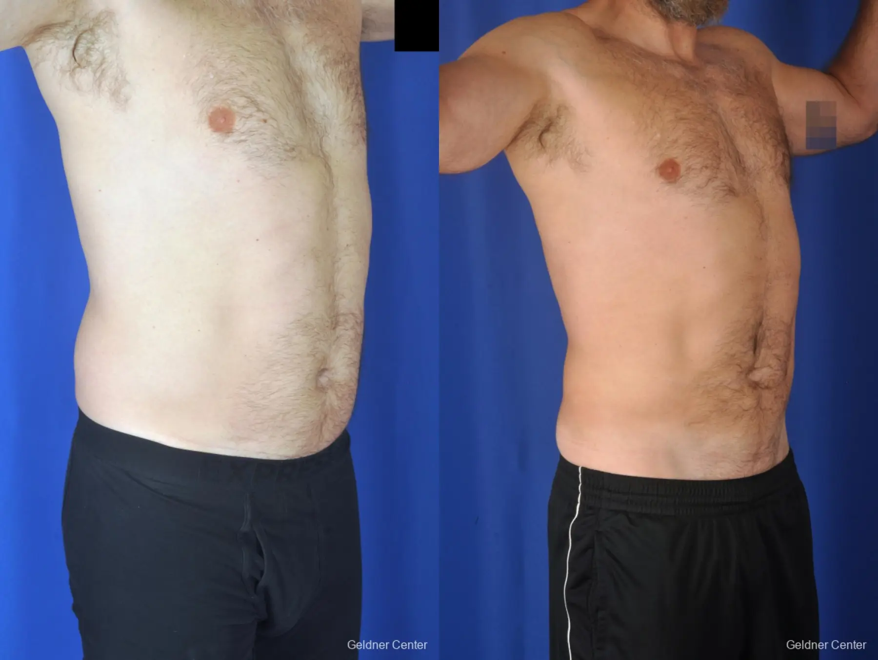 Liposuction For Men: Patient 7 - Before and After 2