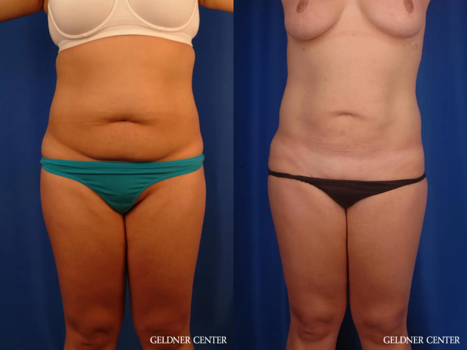 Liposuction: Patient 46 - Before and After  