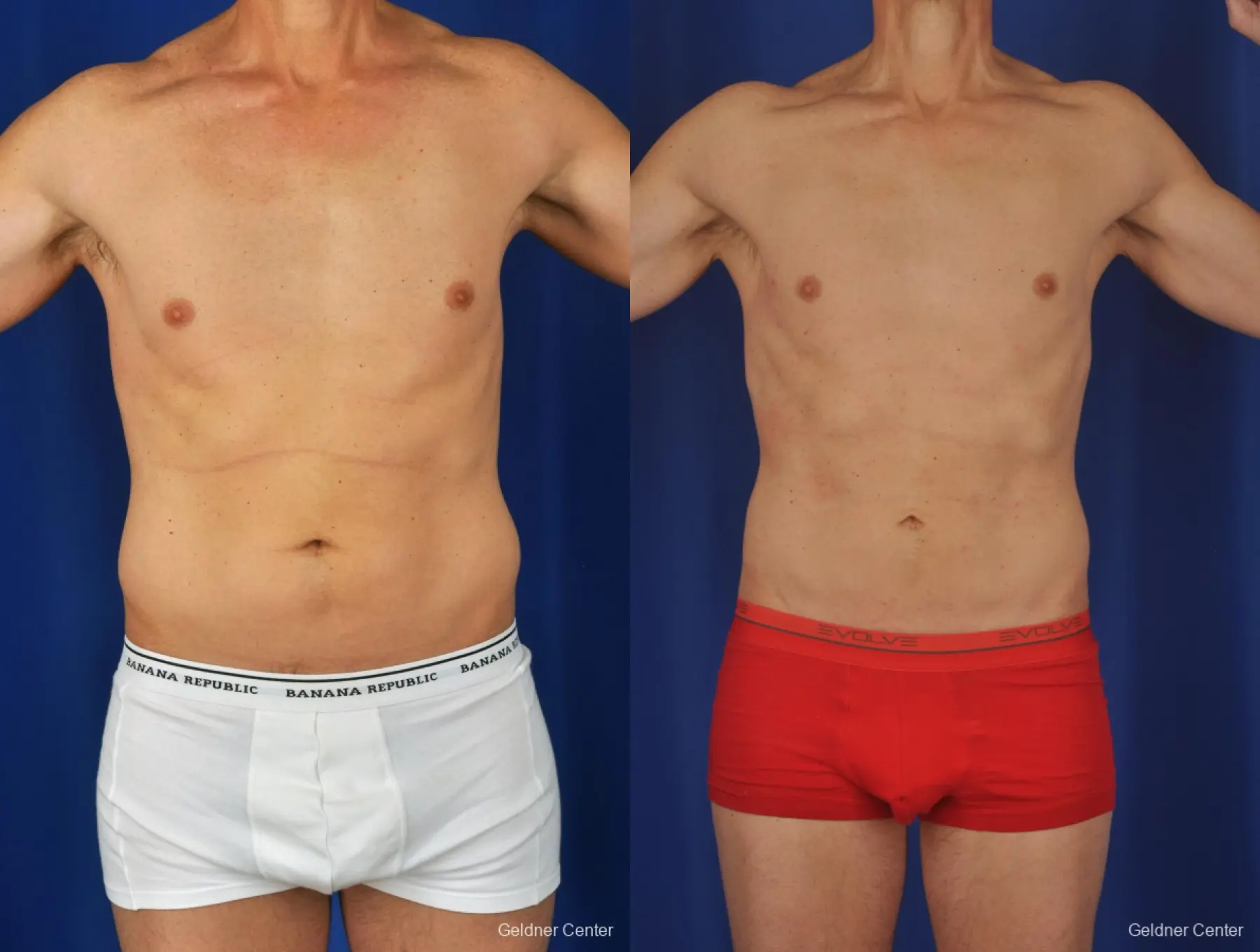 Liposuction-for-men: Patient 2 - Before and After  
