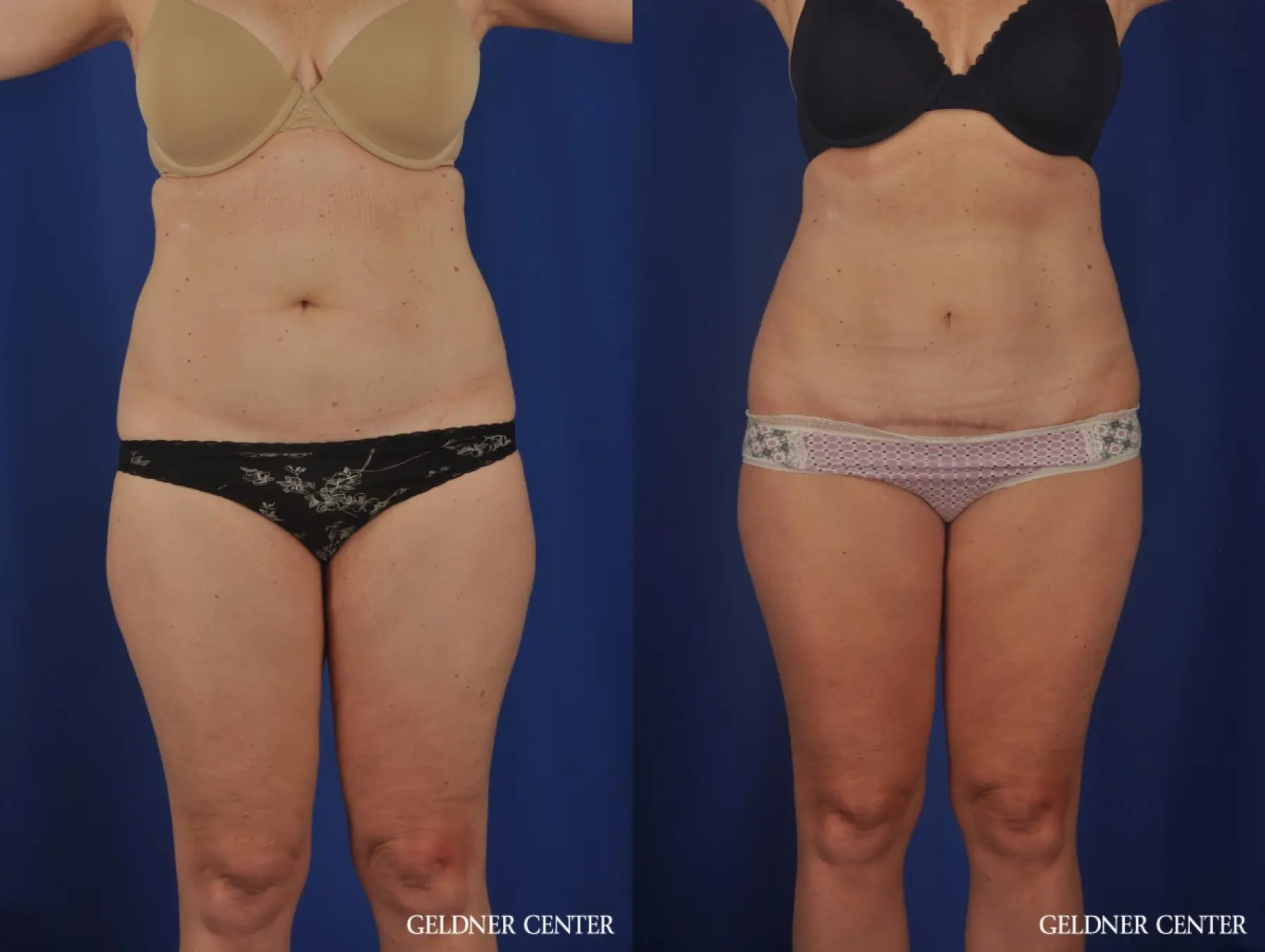 Liposuction: Patient 26 - Before and After 1