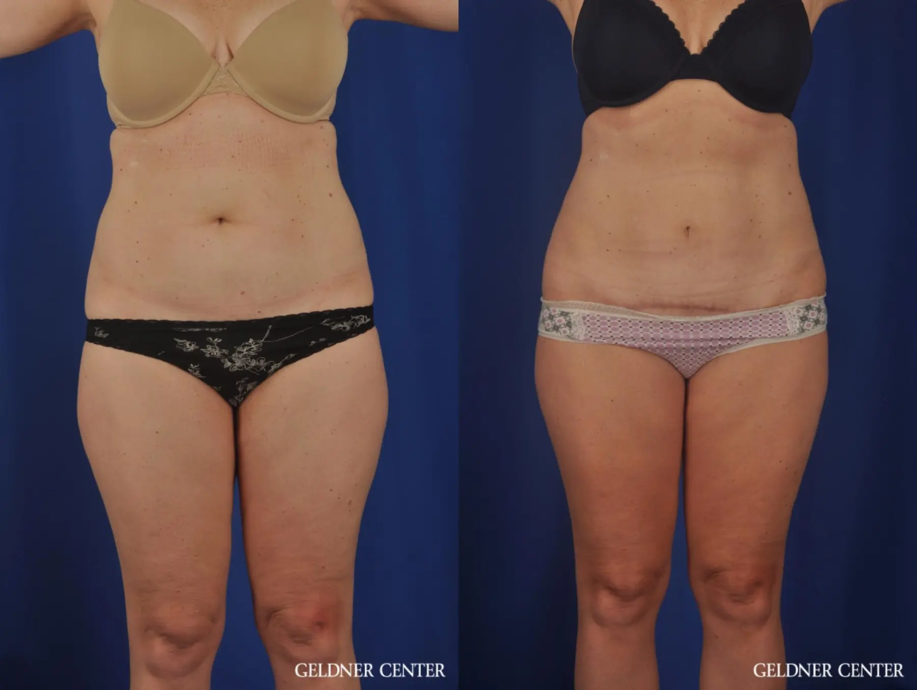 Liposuction: Patient 26 - Before and After  