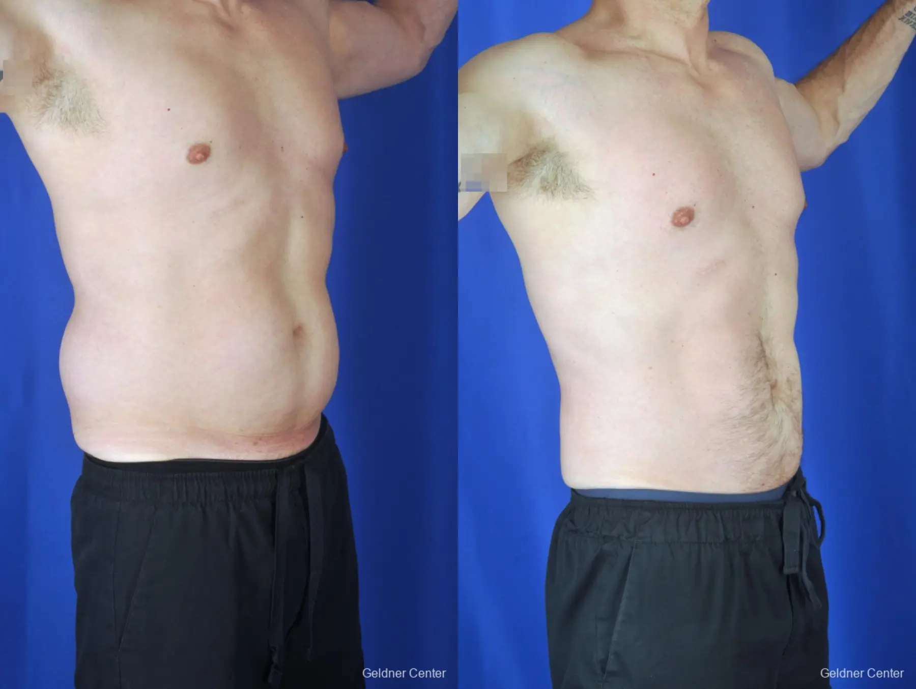 Liposuction For Men: Patient 9 - Before and After 2