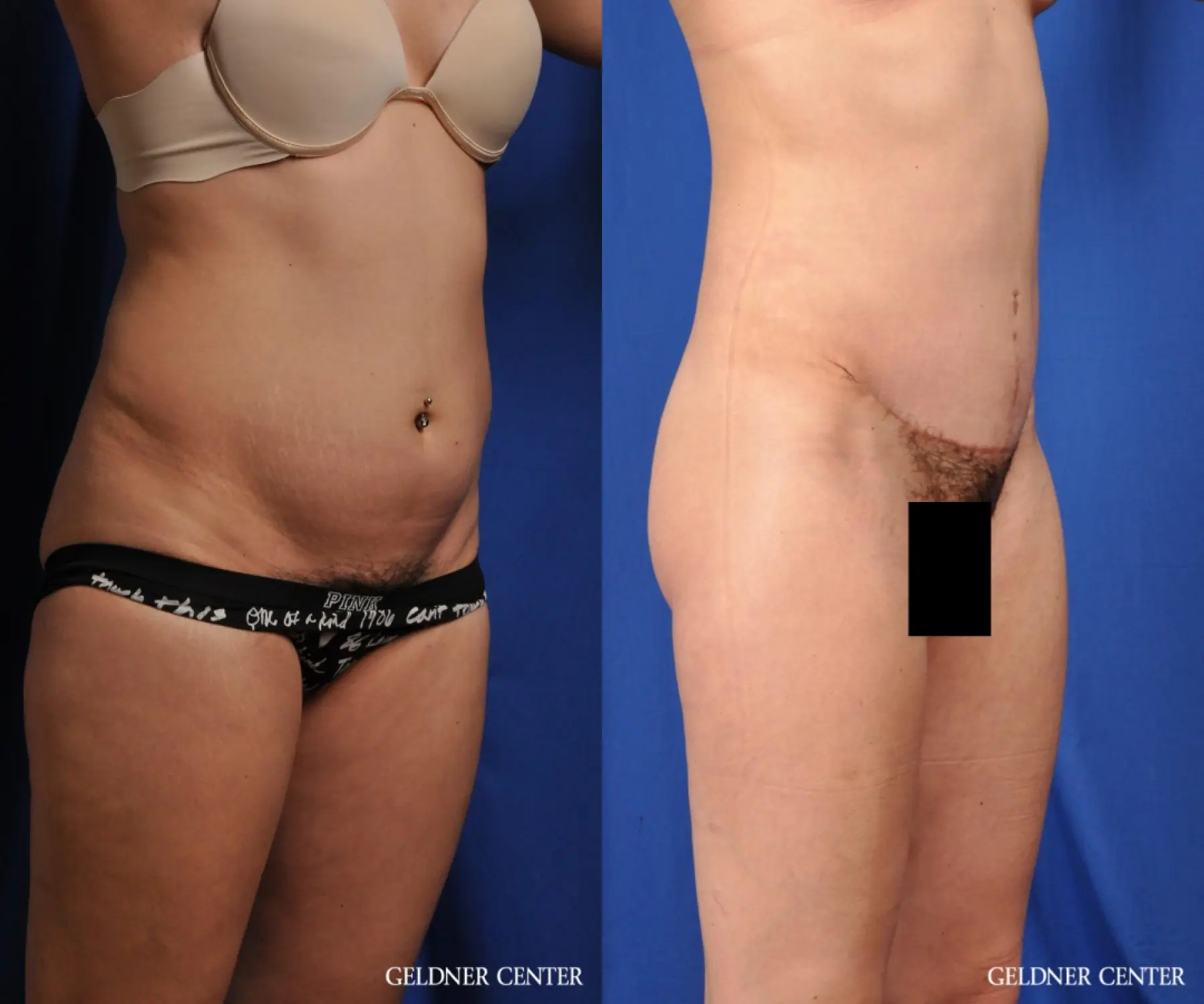 Liposuction: Patient 41 - Before and After 2