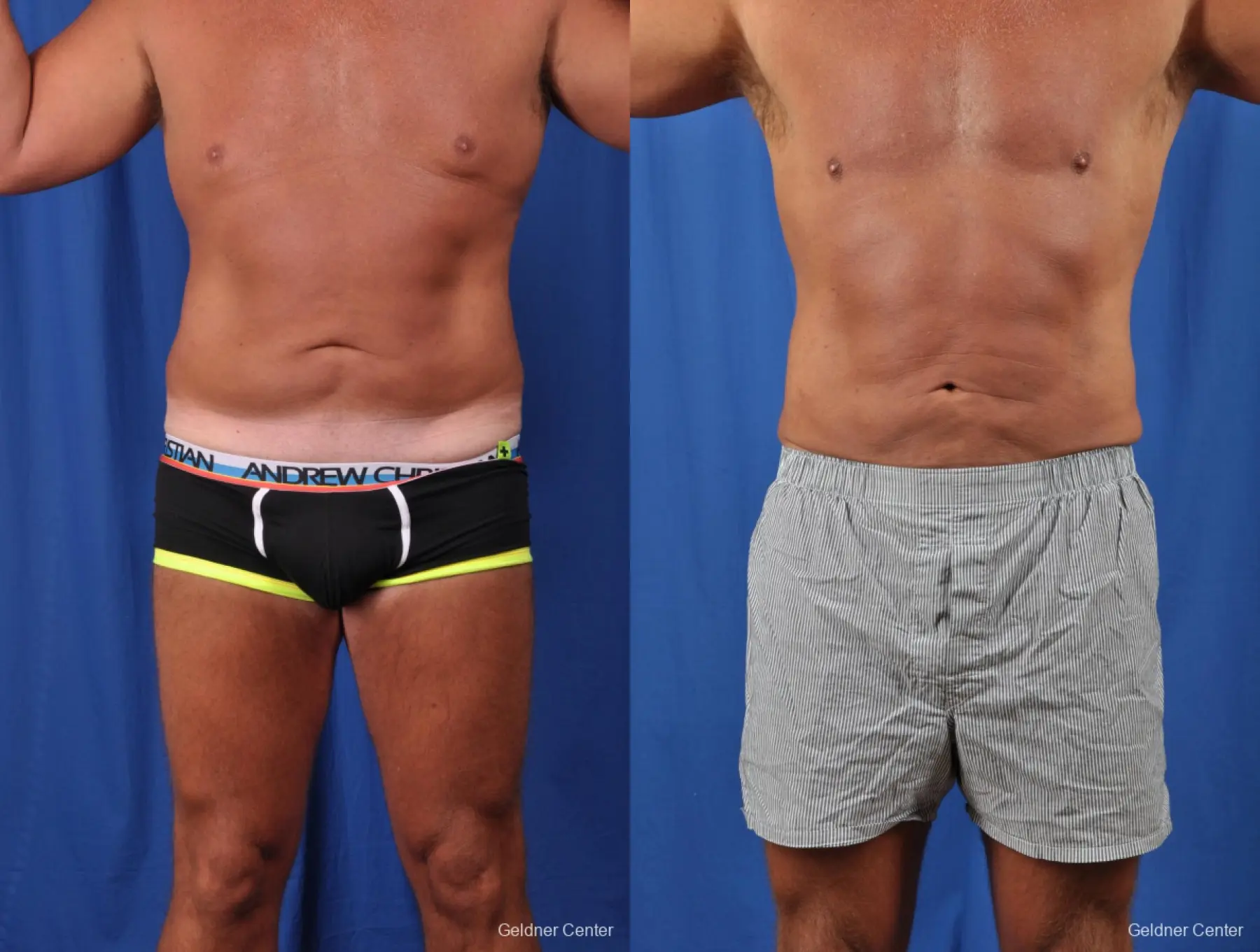 Vaser® Liposculpture Removed About 2700 cc of Fat - Before and After