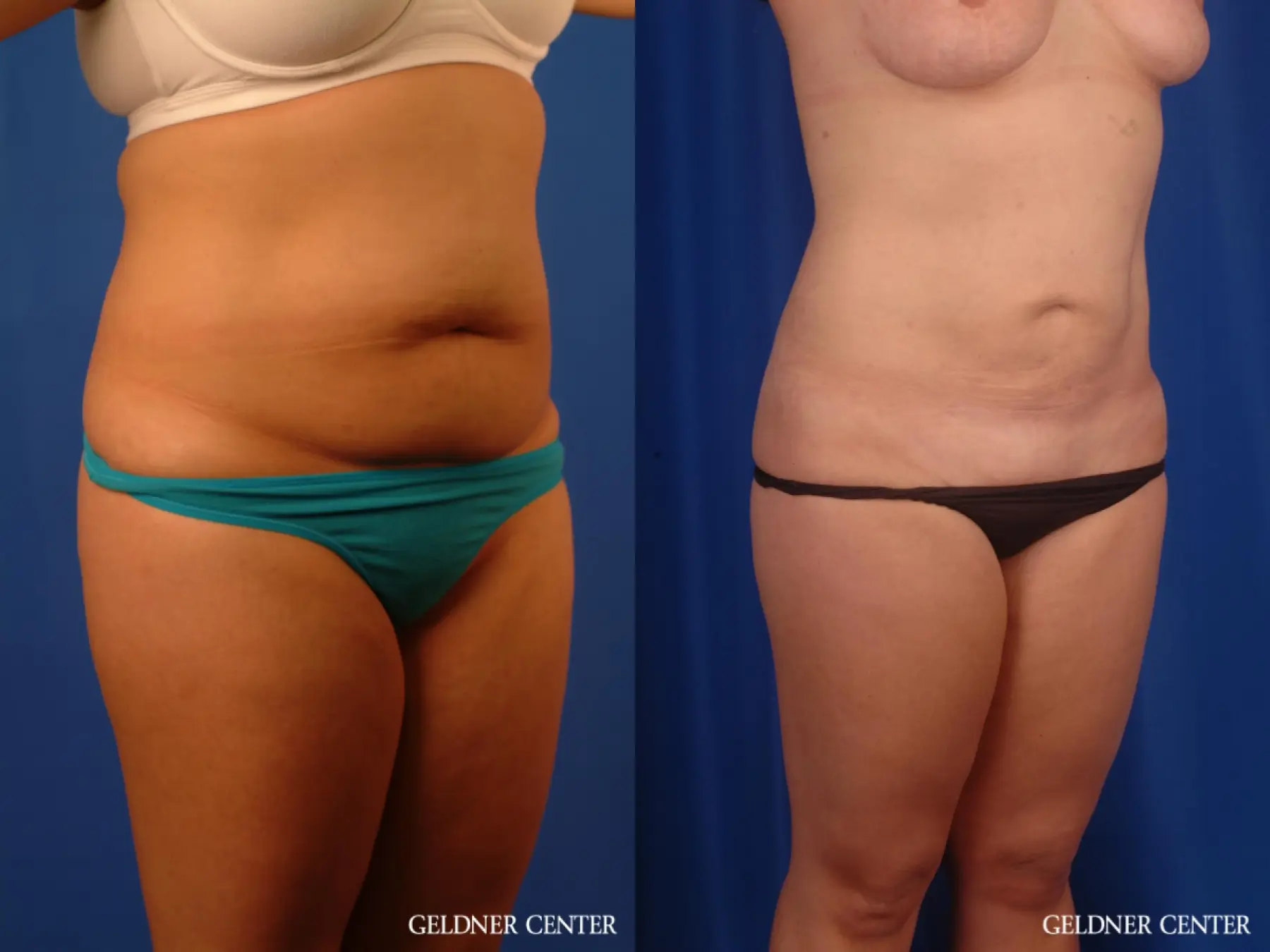 Liposuction: Patient 46 - Before and After 2