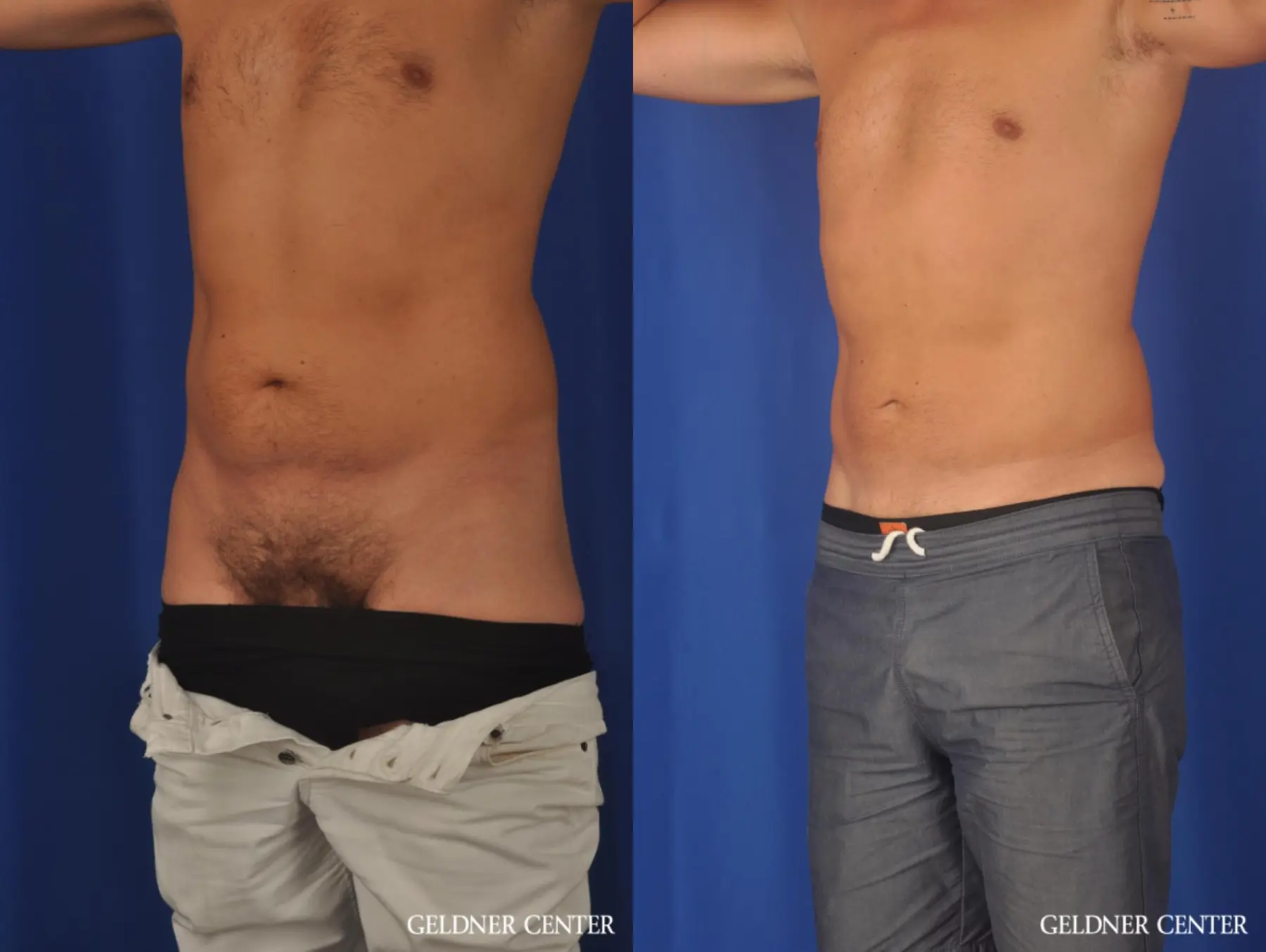 Liposuction For Men: Patient 12 - Before and After 4