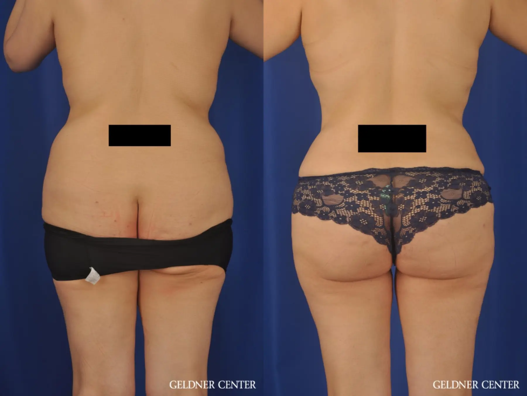 Liposuction: Patient 31 - Before and After 4