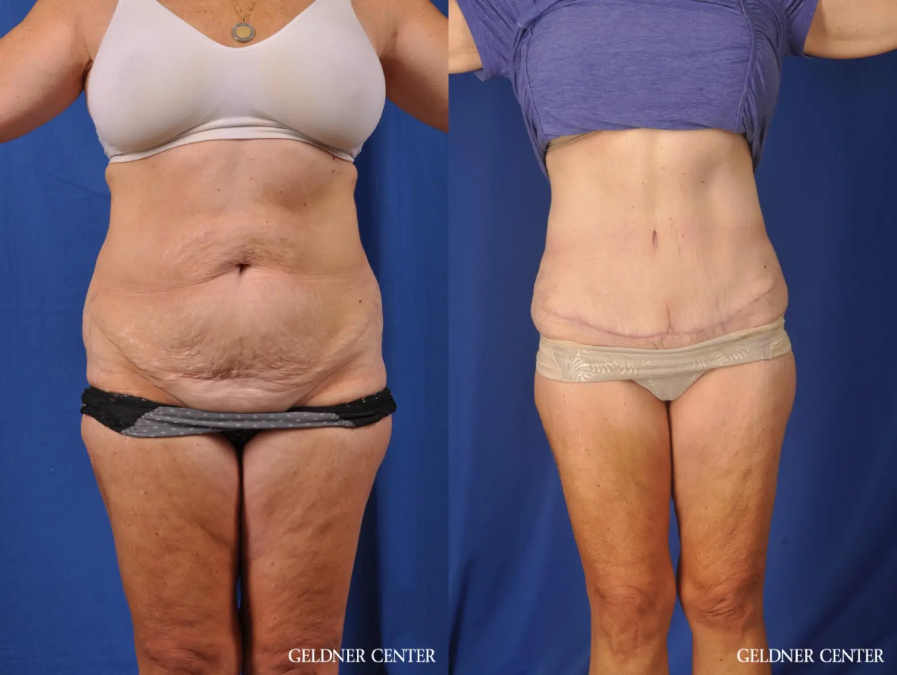 Liposuction: Patient 34 - Before and After  