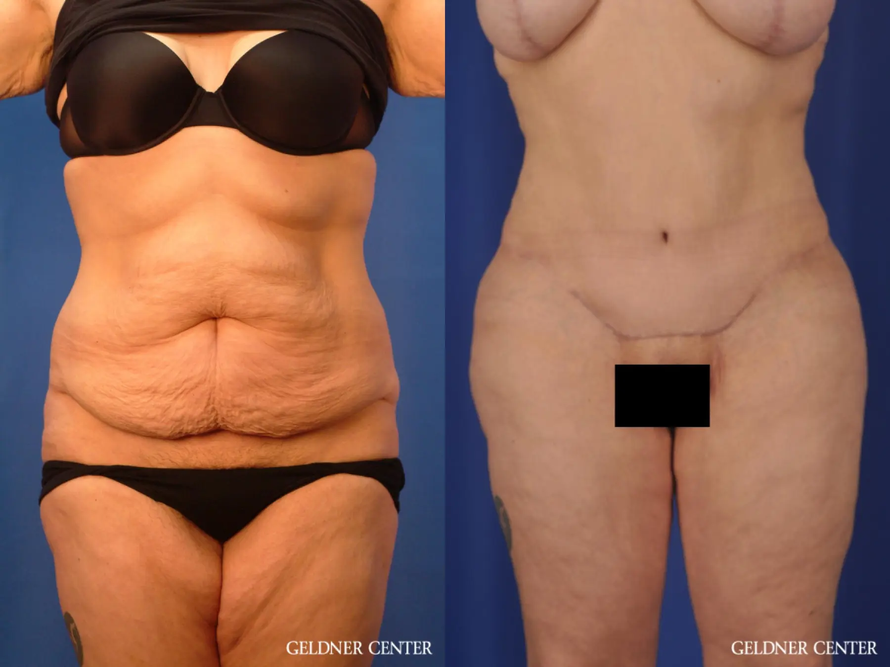 Liposuction: Patient 23 - Before and After  