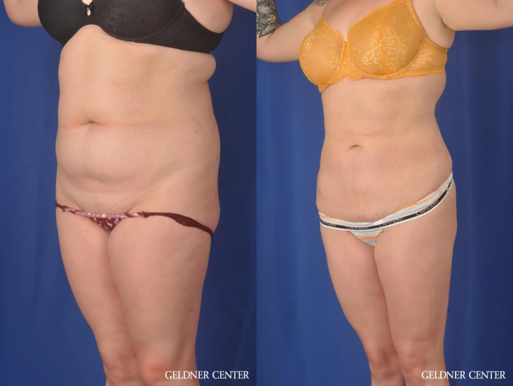 Liposuction: Patient 45 - Before and After 5