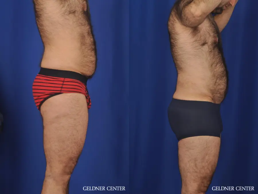 Liposuction For Men: Patient 10 - Before and After 3