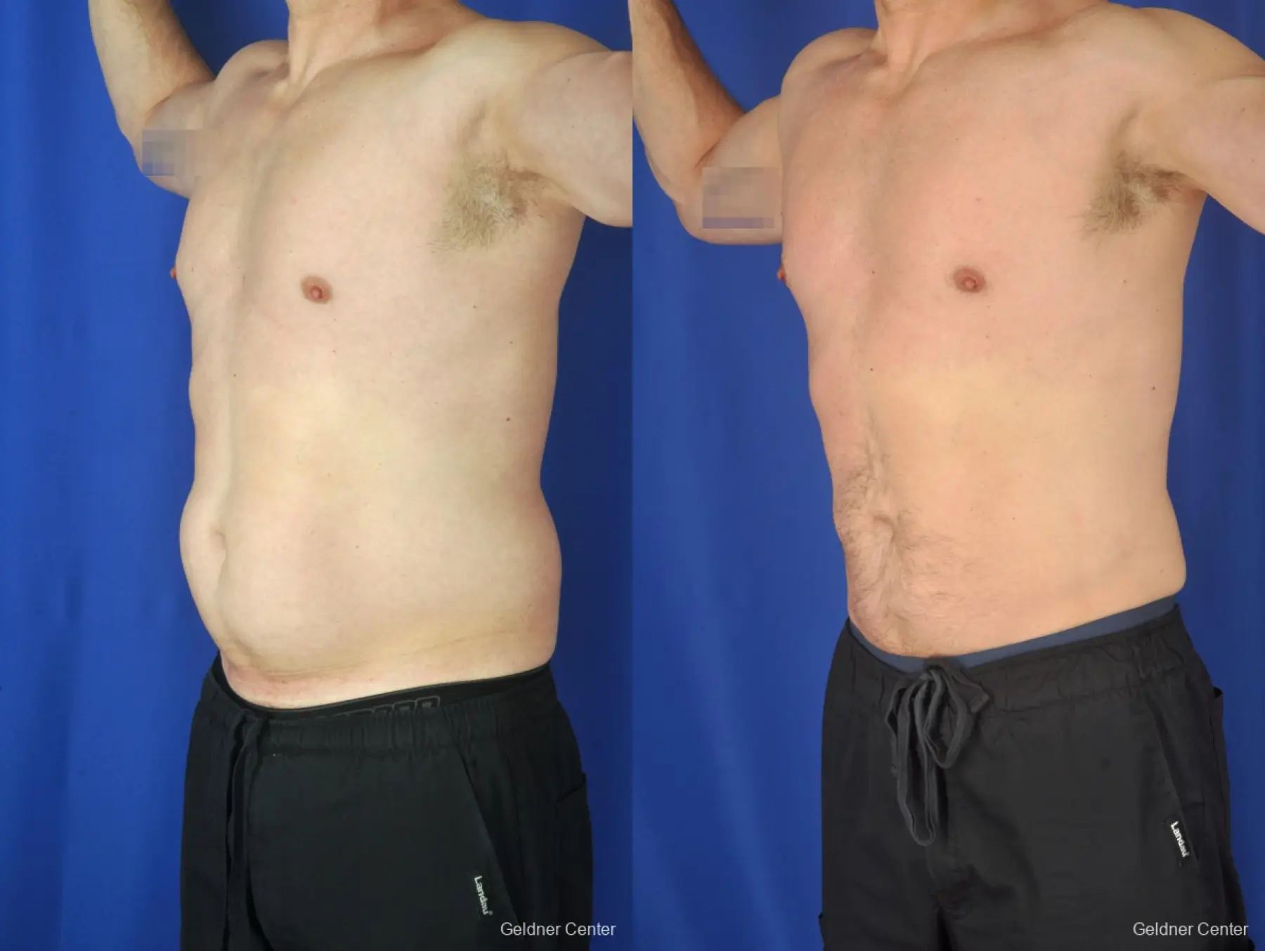 Liposuction For Men: Patient 9 - Before and After 5