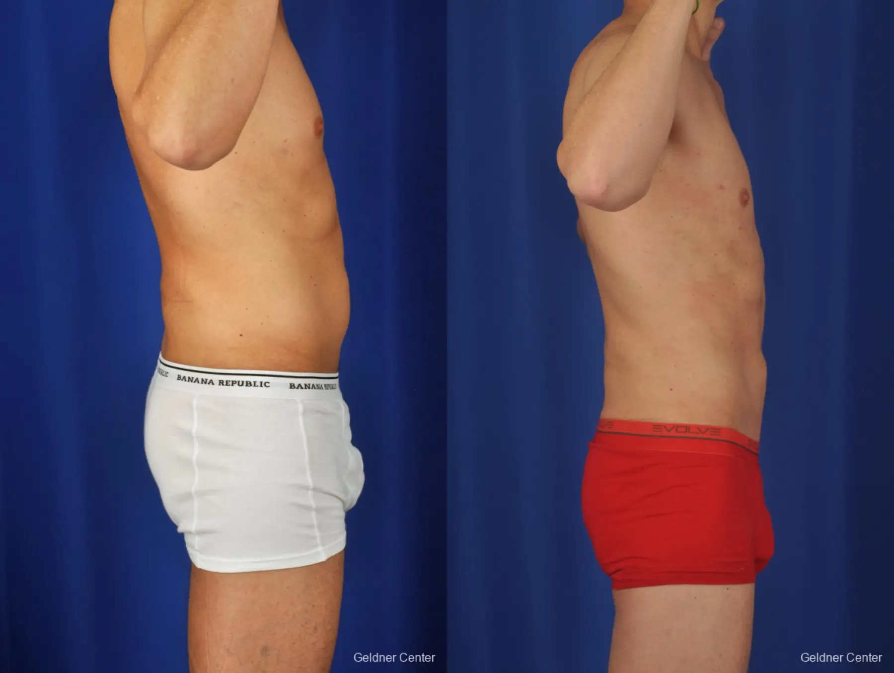 Liposuction For Men: Patient 2 - Before and After 3