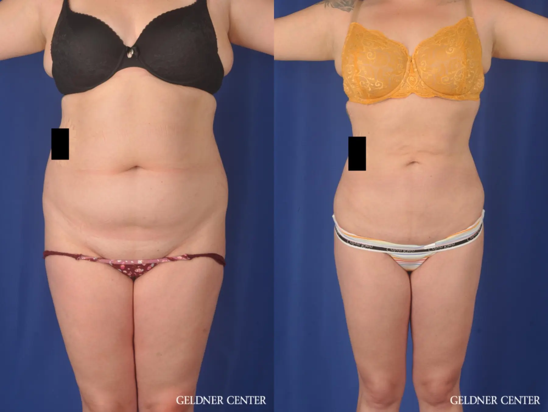 Liposuction: Patient 45 - Before and After  