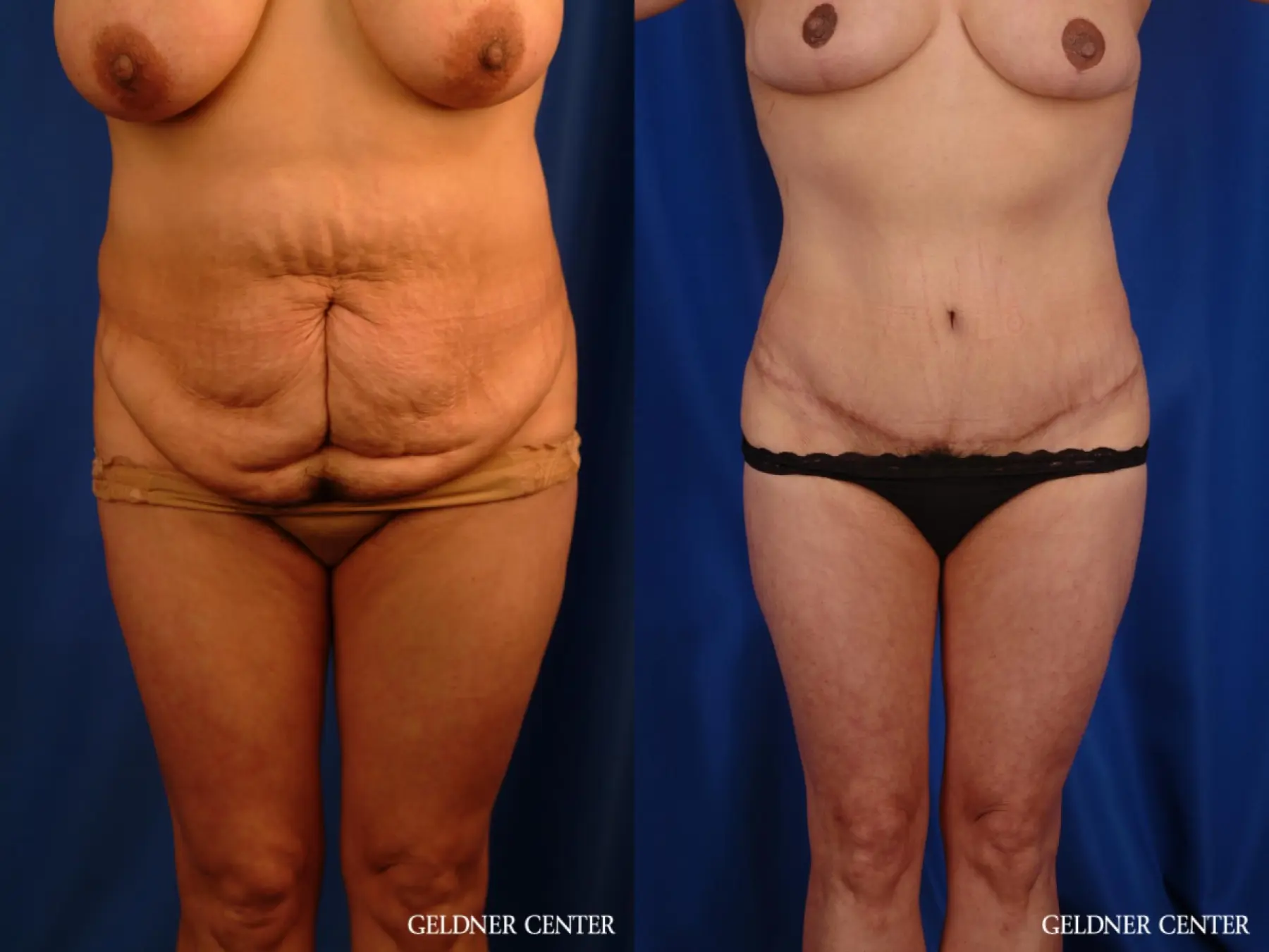 Liposuction: Patient 21 - Before and After  