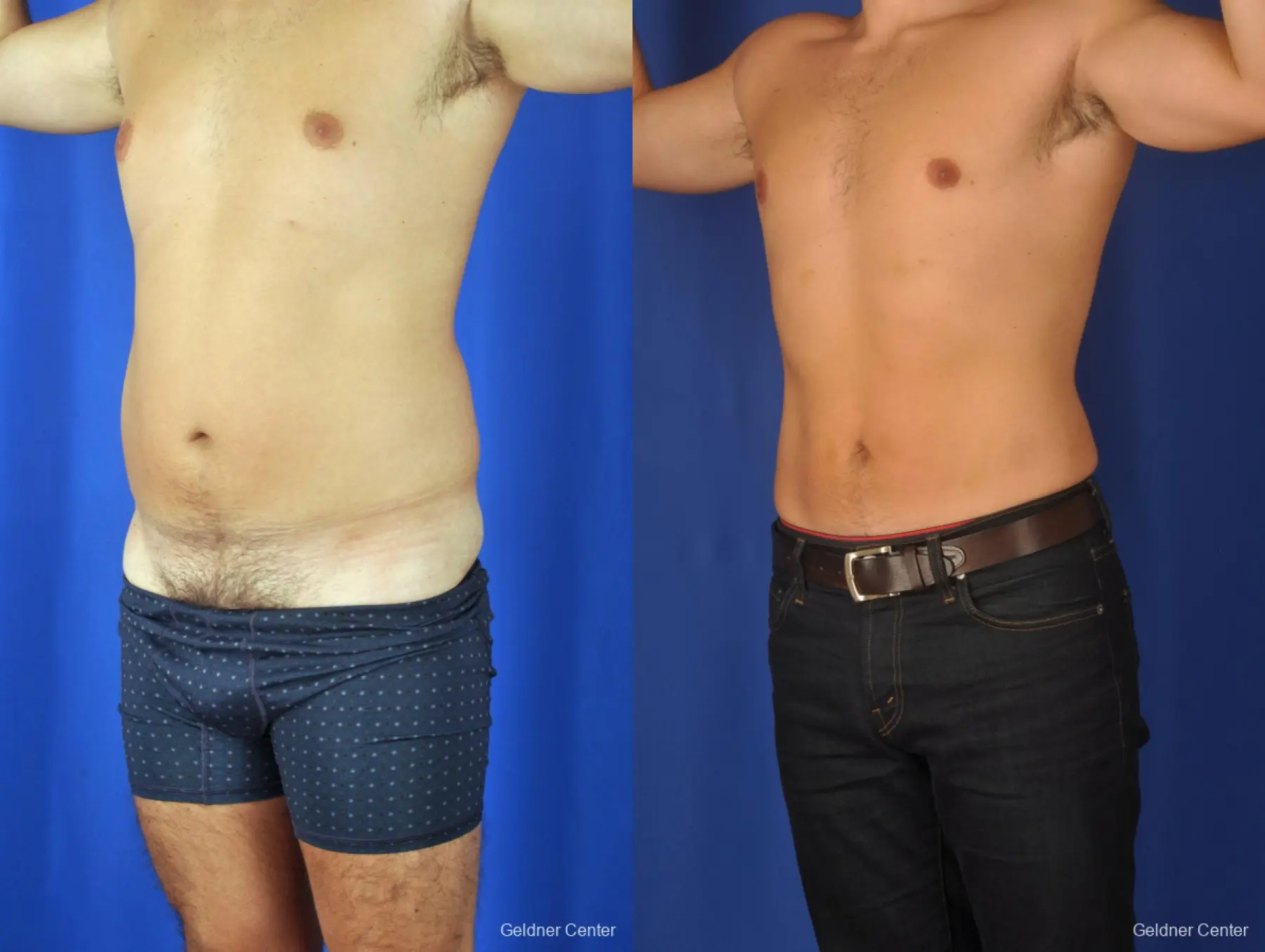 Liposuction For Men: Patient 4 - Before and After 5