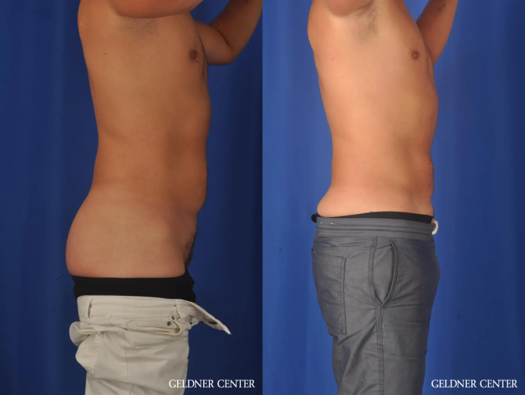Liposuction For Men: Patient 12 - Before and After 3