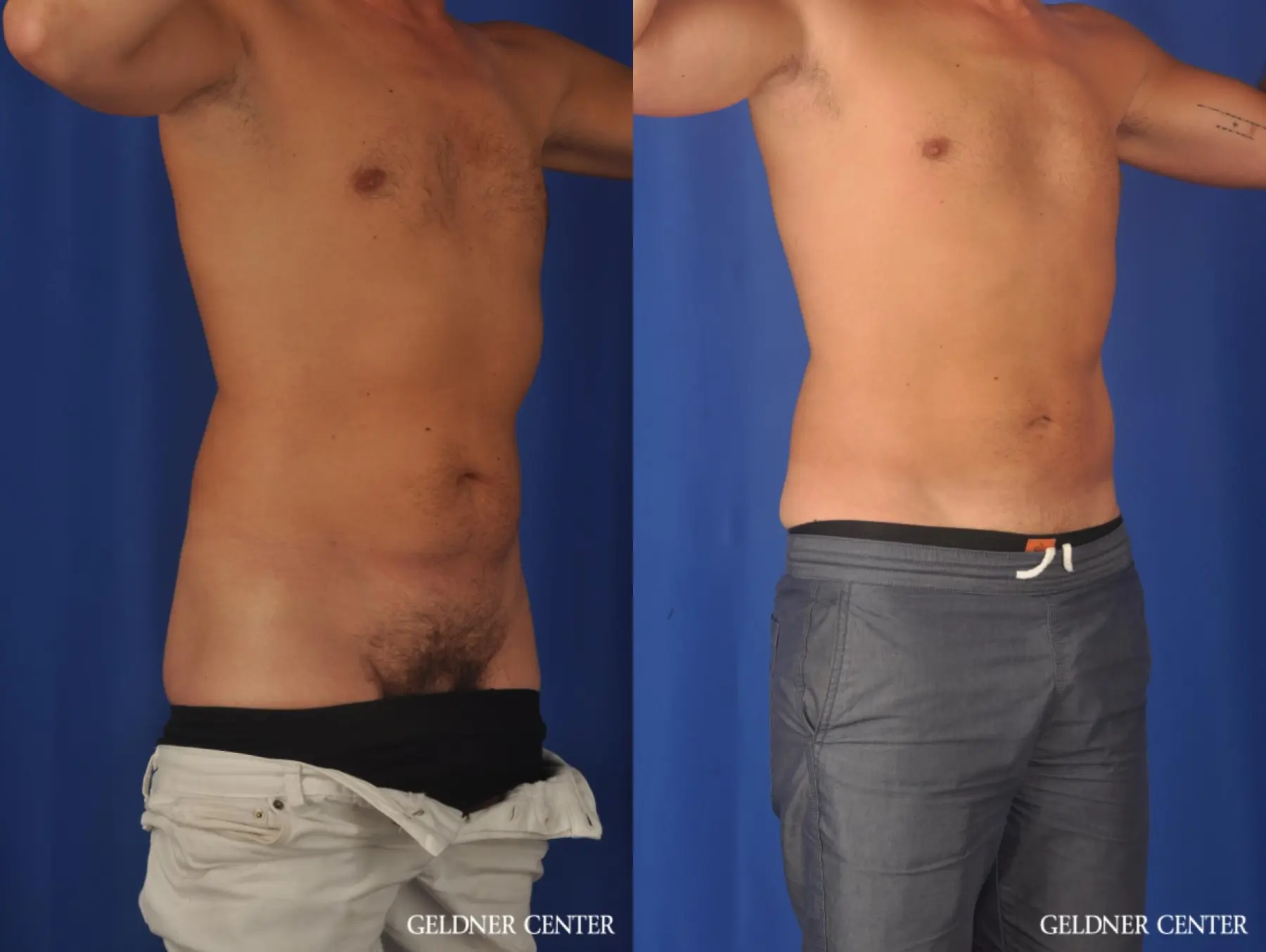 Liposuction For Men: Patient 12 - Before and After 2