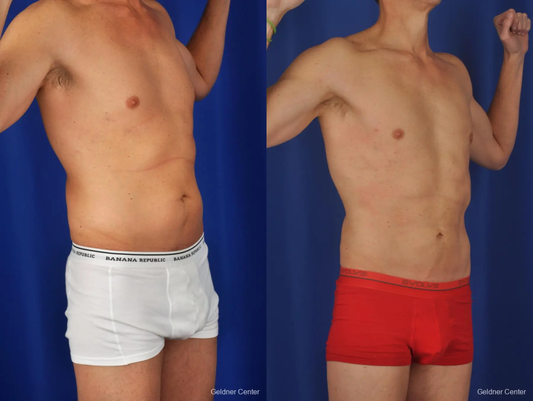 Liposuction For Men: Patient 2 - Before and After 2
