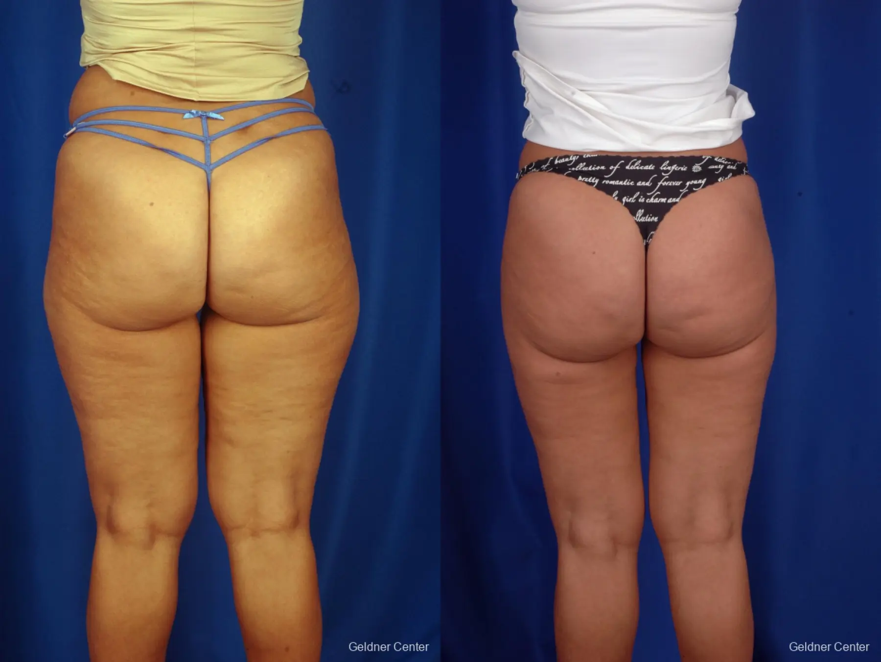 Liposuction: Patient 7 - Before and After 4