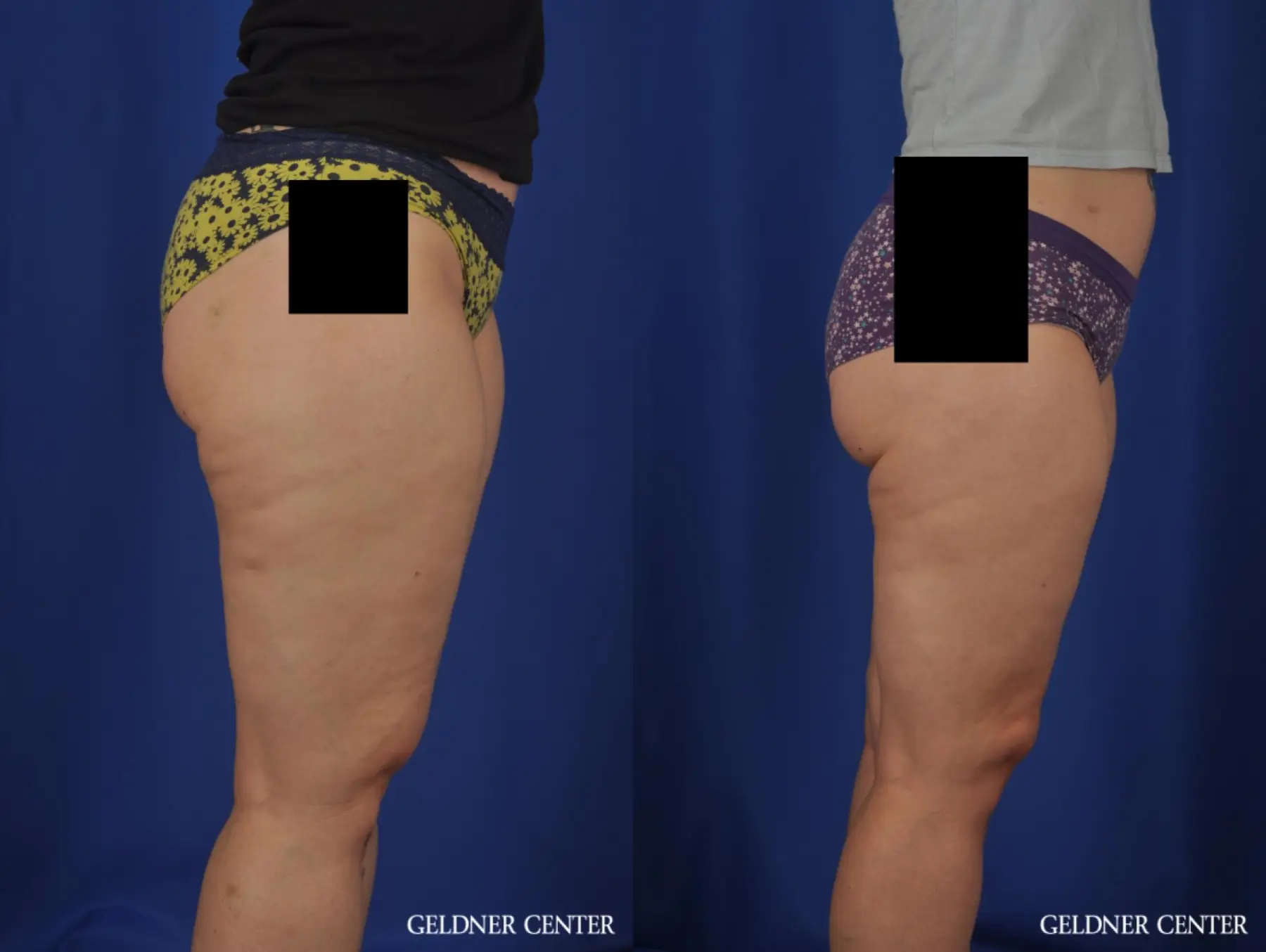 Liposuction: Patient 44 - Before and After 3