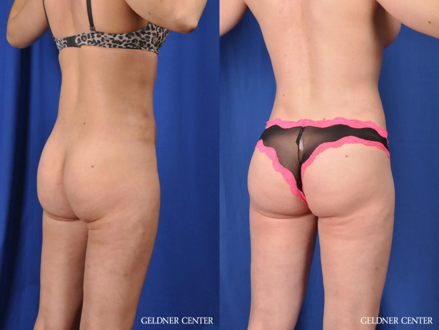 Liposuction: Patient 27 - Before and After 4