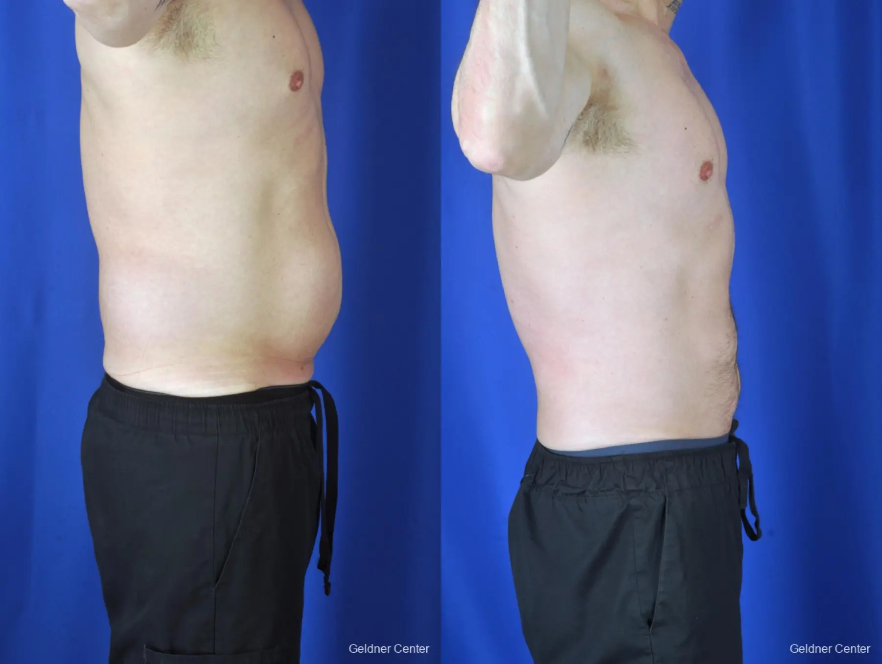 Liposuction For Men: Patient 9 - Before and After 3